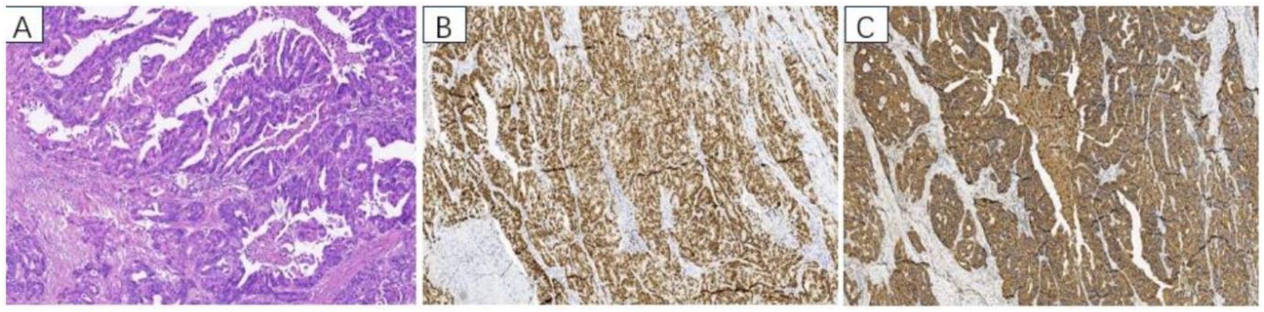 Histological images in three panels labeled A, B, and C. Panel A shows tissue stained with purple hues, typical of hematoxylin and eosin staining, revealing different cell structures. Panels B and C display brown-stained tissues, likely immunohistochemical staining, highlighting specific protein expressions. White spaces in all panels indicate the separation within tissue structures.