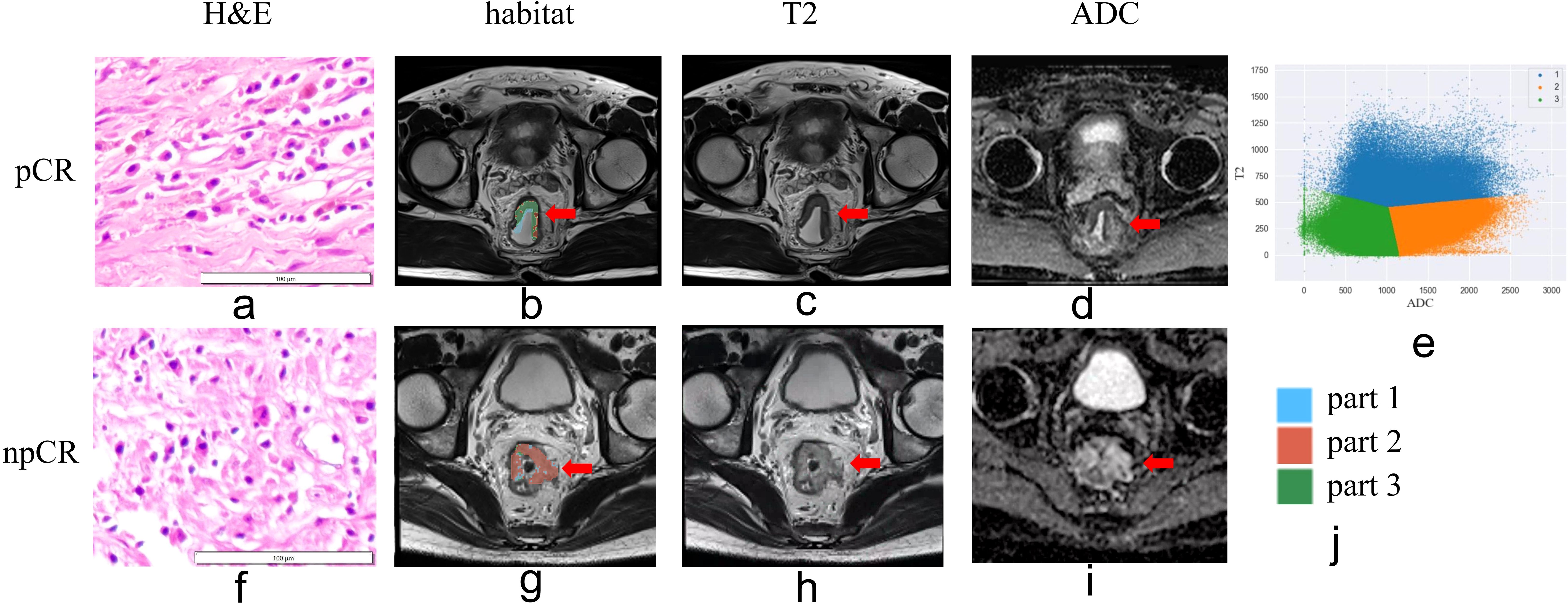 H&E stained tissue images (a, f) show different cellular structures for pCR and npCR. MRI images (b, c, d, g, h, i) display corresponding anatomical sections with highlighted areas using arrows in habitat, T2, and ADC scans. A scatter plot (e) represents ADC vs. T2 values with color-coded parts 1, 2, and 3, explained in the legend (j).