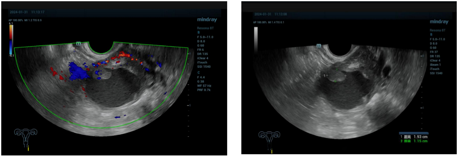 Two ultrasound images display internal structures with measurements. The left image uses Doppler color coding, highlighting areas of blood flow in red and blue. The right image shows a grayscale view with measurements of a feature noted as 1.93 centimeters and 1.15 centimeters, without color coding. Both images have technical details on the right.