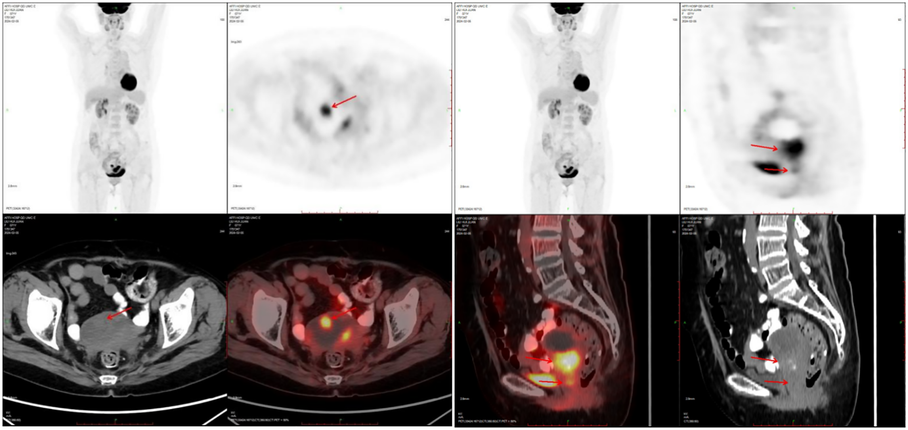 PET-CT scan series displaying axial, coronal, and sagittal views with arrows indicating areas of abnormal uptake. Multiple images show varied cross-sections of the body, highlighting regions with increased radiotracer activity suggestive of areas of interest for diagnosis.