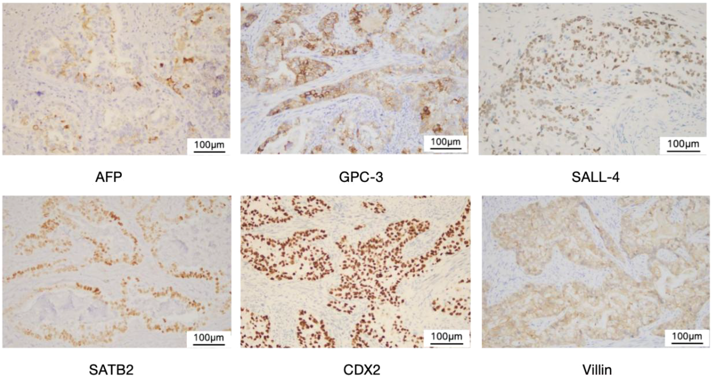Six microscopic images show tissue samples stained for markers AFP, GPC-3, SALL-4, SATB2, CDX2, and Villin. Each image shows varying patterns and intensities of brown staining against a pale background. Scale bars indicate 100 micrometers.