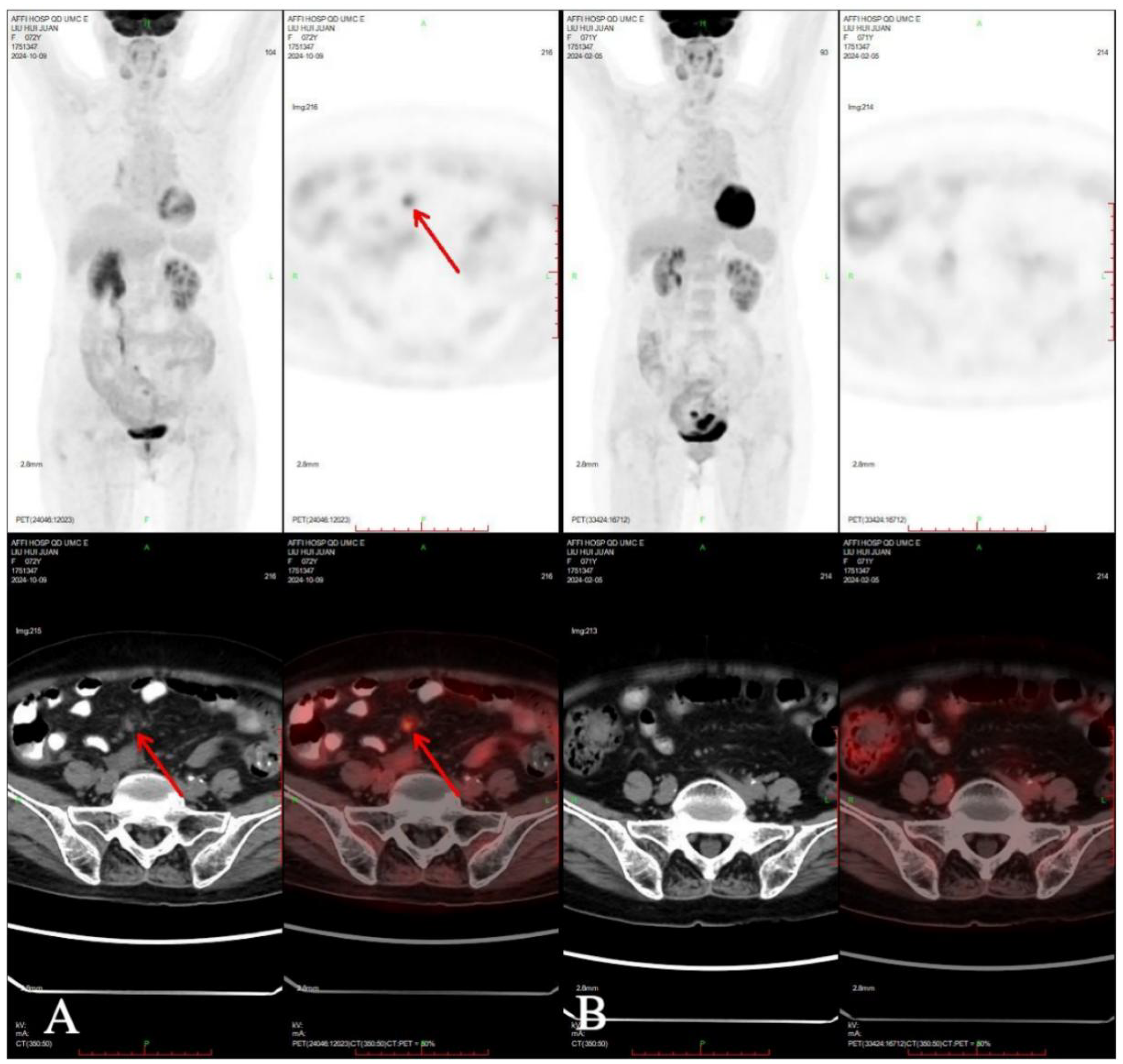PET/CT scans showing regions of interest. The top row shows full-body scans with areas of increased metabolic activity, highlighted by red arrows in the middle images. The bottom row presents cross-sectional views with similar indications of activity. The arrows point to specific areas for diagnostic focus.