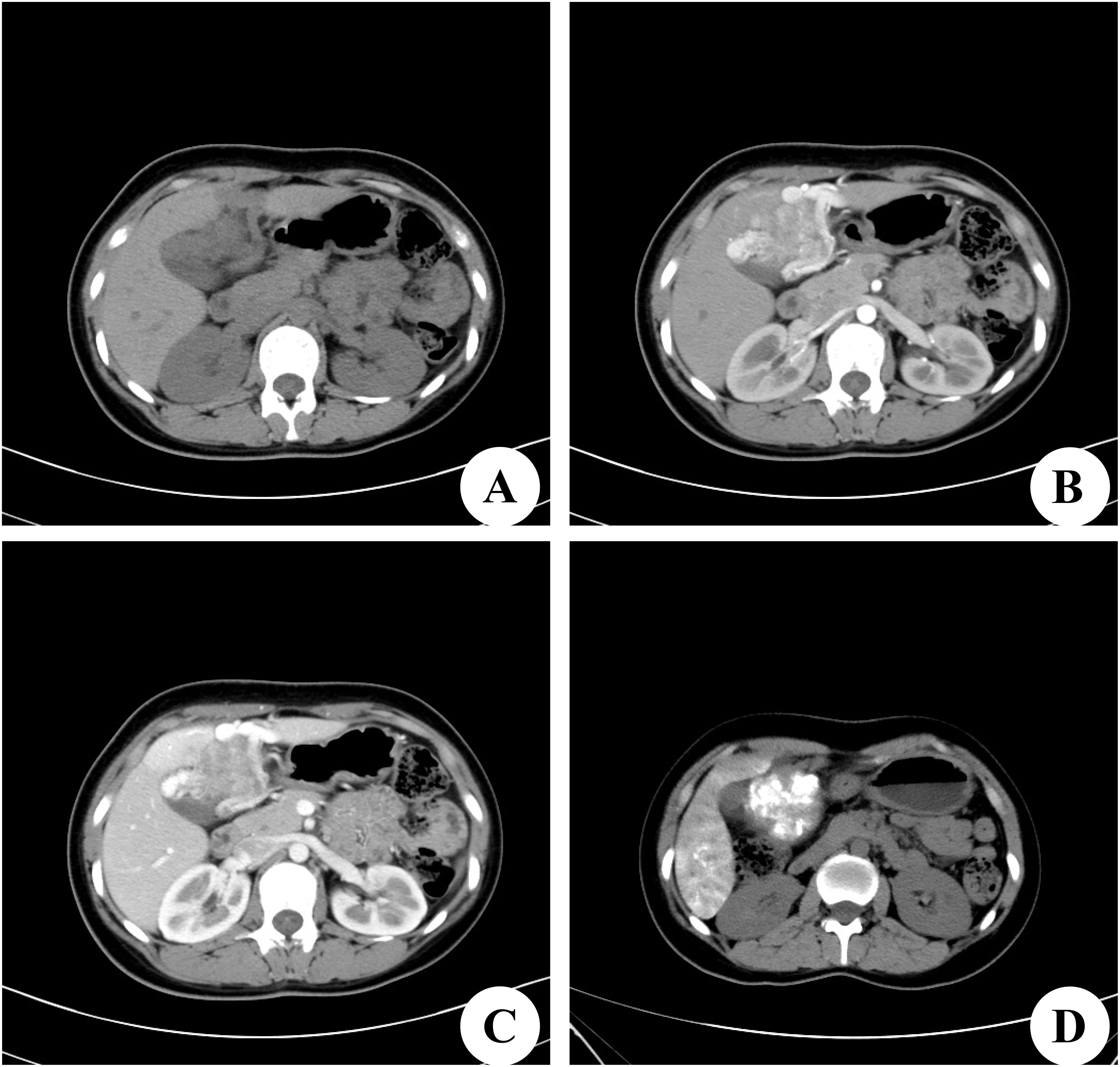 Four-panel CT scan images labeled A, B, C, and D, show cross-sectional views of the abdominal area. Differences in shading and density indicate variations in tissue and organ structures across the panels.