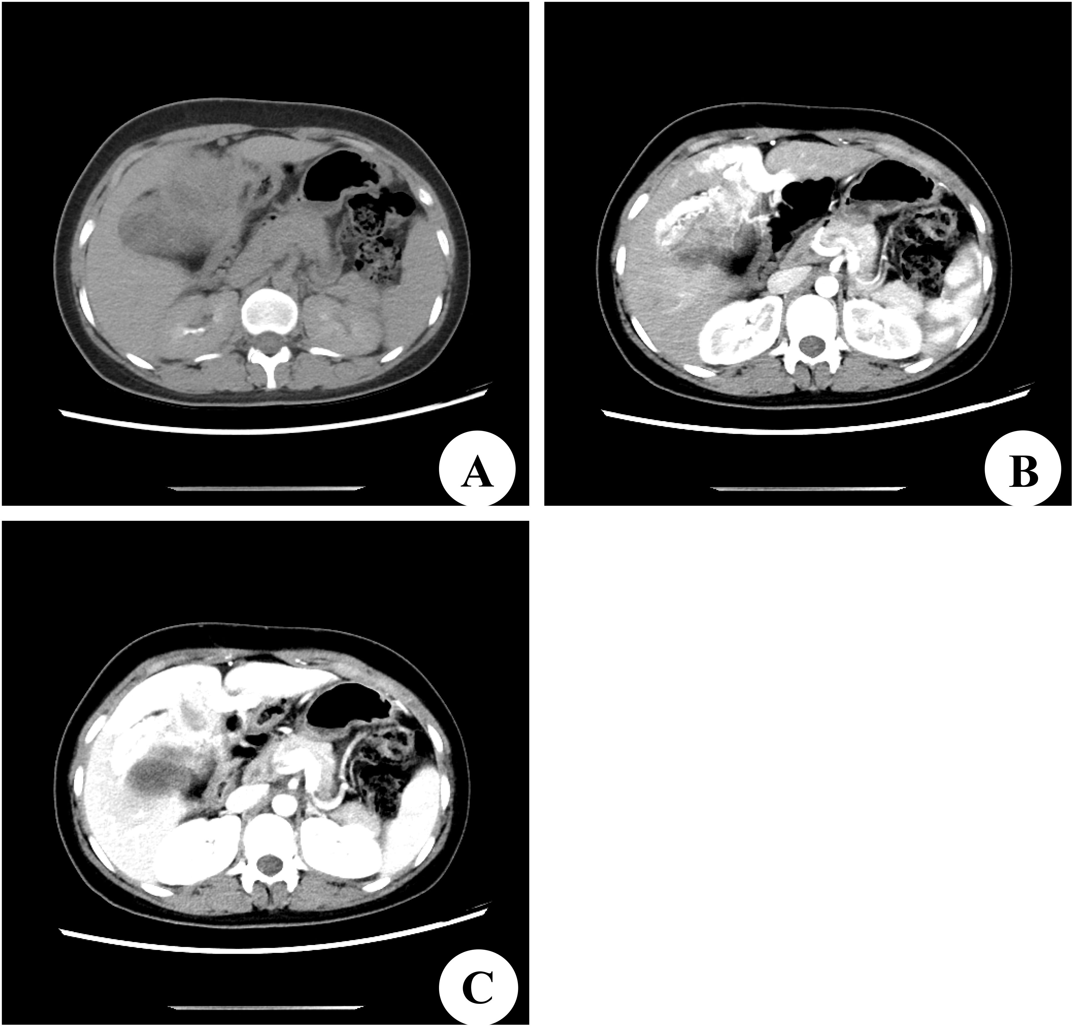 CT scans of an abdomen showing different stages of contrast enhancement. Image A shows a non-enhanced scan, Image B shows arterial phase enhancement, and Image C shows venous phase enhancement. Each image highlights anatomical structures against varying contrast levels.