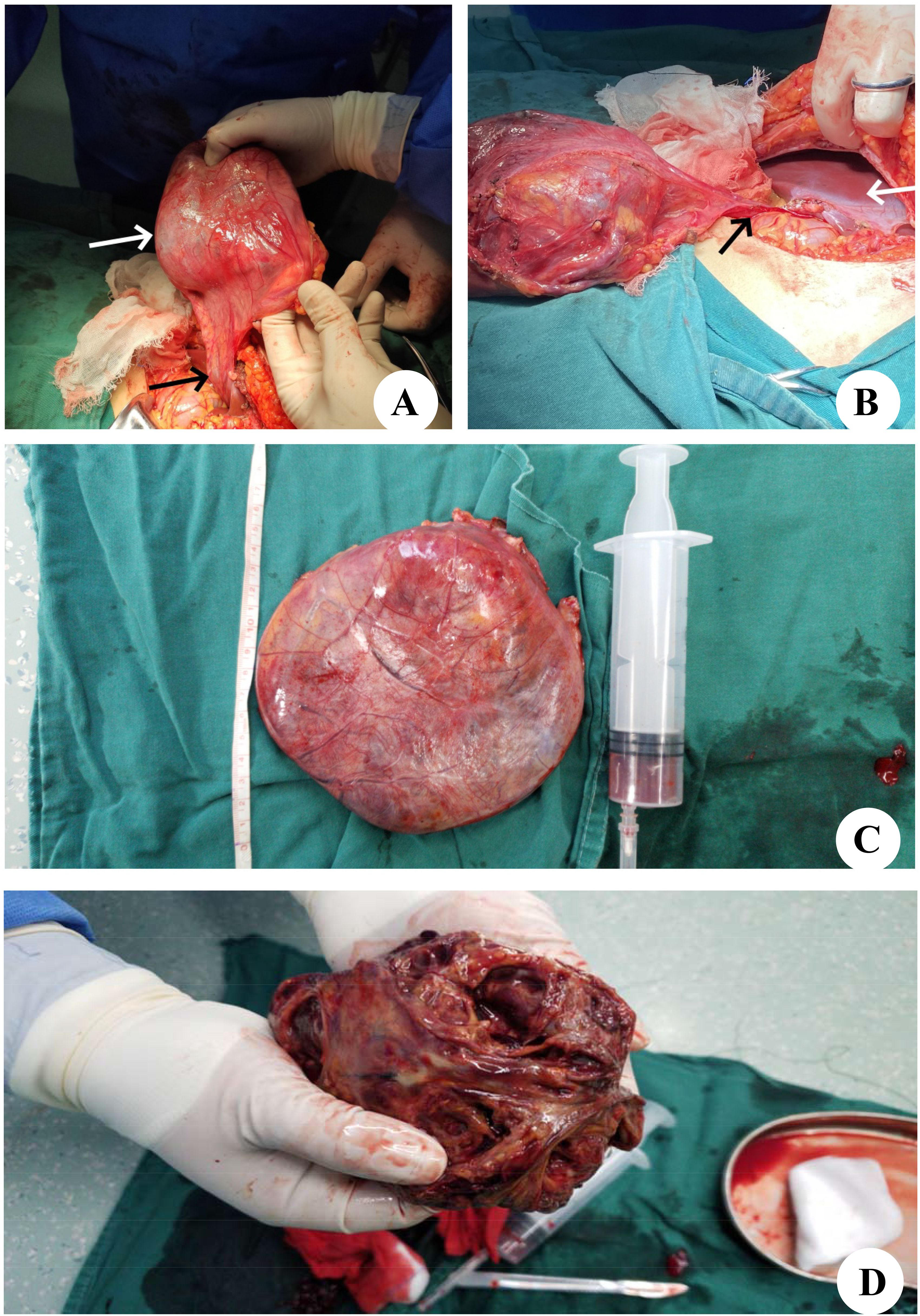 Panel A shows hands holding a large, reddish mass with arrows indicating specific areas. Panel B illustrates the mass placed beside an incision, with two arrows highlighting points of focus. Panel C features the mass positioned on a surgical drape next to a syringe. Panel D depicts gloved hands holding a darker, textured mass with surgical tools nearby.