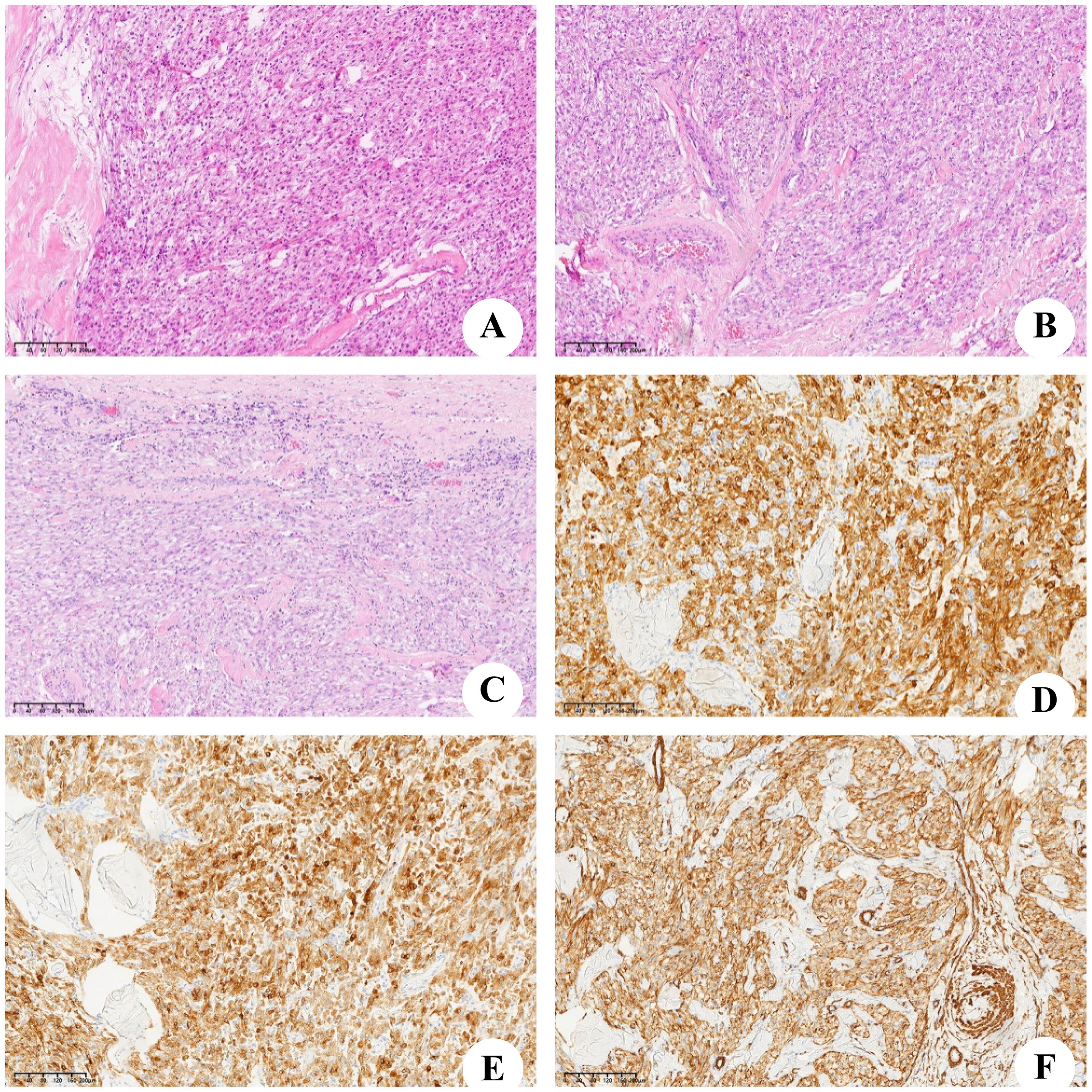 Histological images labeled A through F. Images A, B, and C display tissue samples stained pink and purple, showing cellular patterns typical of H&E staining. Images D, E, and F exhibit brown-stained tissues, indicating immunohistochemical staining. Each image highlights different tissue characteristics and staining techniques. The scale is visible for reference in each image.