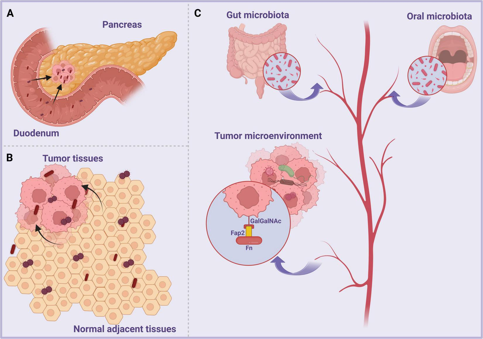 Diagram illustrating interactions between the pancreas, tumor tissues, and microbiota in cancer progression. Panel A shows a pancreas with tumor in the duodenum. Panel B depicts tumor tissues among normal tissues. Panel C illustrates how gut and oral microbiota, indicated by bacteria, interact with the tumor microenvironment, highlighting GalGalNAc, Fap2, and Fn interactions. Arrows show connections between elements.