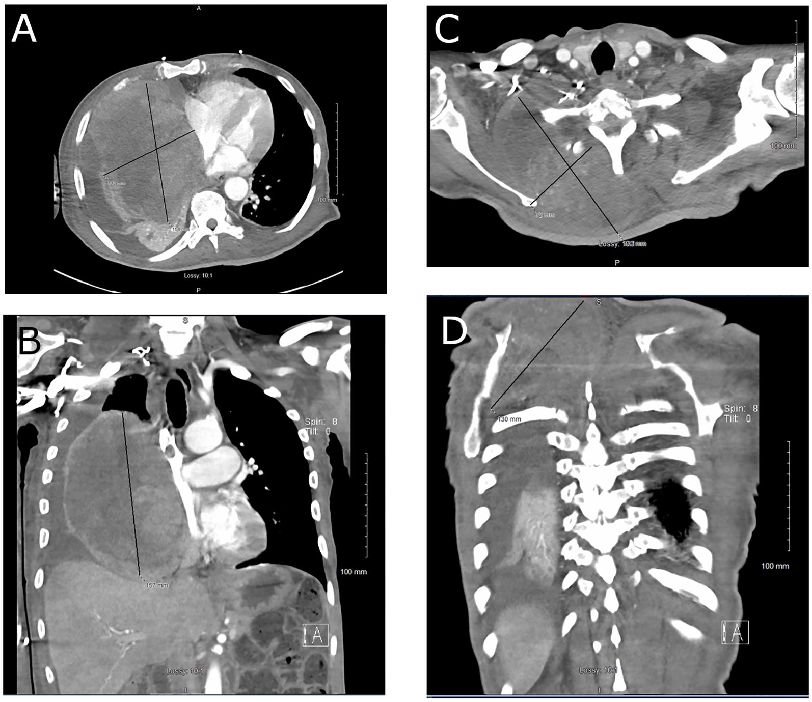CT scans of the chest and neck. Panel A displays an axial view and Panel B displays a coronal view of the chest demonstrating replacement of the right middle and lober lobes of the lung by a large malignant PEComa. Panel C display an axial view and Panel D displays a coronal view of the neck showing the right dorsal component of the tumor displacing the right scapula.