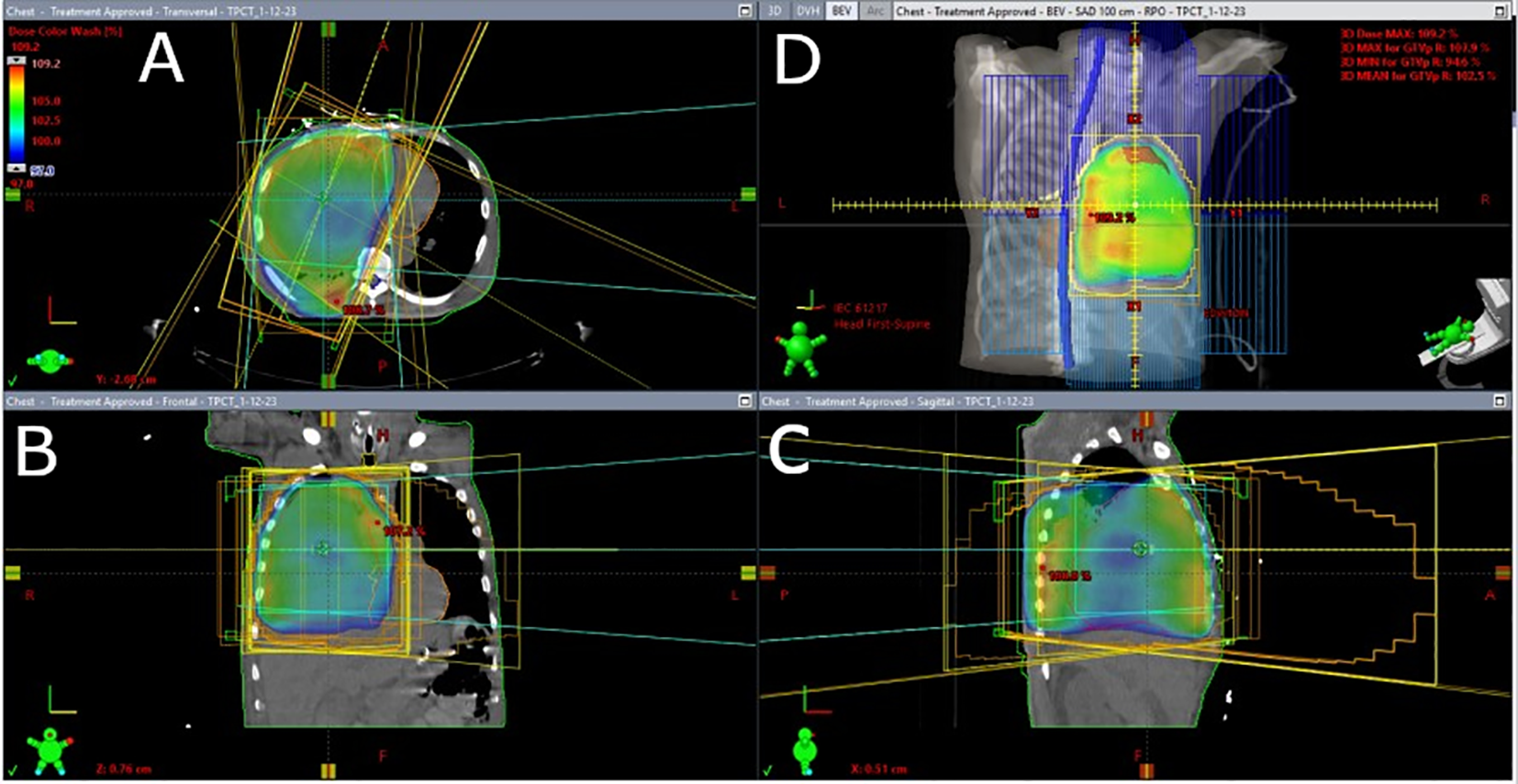Palliative 3D conformal radiation treatment plan to the right upper lobe, right lower lobe, and right hilum. Each panel displays a cross-sectional view of the chest with color wash depicting the calculated 3D radiation dose distributions; dose intensity is denoted by color intensity and geometric contours outline treatment areas. Panel A displays the axial view, Panel B displays the coronal view, panel C displays the sagittal view, and panel D displays the beam's eye view showing a treatment volume encompassing the majority of the right lung to treat progressive gross disease. Three prescription dose levels are depicted: blue areas received 100% of the prescription dose, 20 Gy, green areas received 102-105% of the prescription dose, and red areas received 109% of the prescription dose with a global point maximum (Dmax) of 109.2% landing in an inferior right intercostal space.