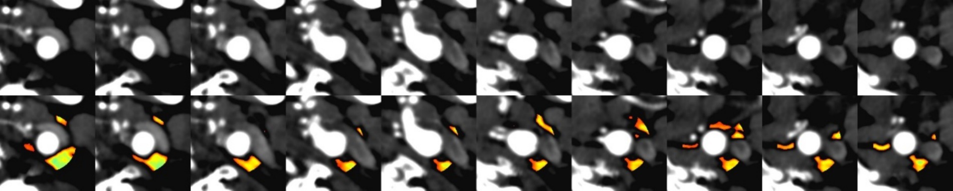 Two rows (10 images each) of medical scans. Top row: Conventional CTA cross-sections showing white circular vessels. Bottom row: Fat-density extraction images with yellow highlights indicating perivascular adipose tissue (PVAT) distribution around vessels.