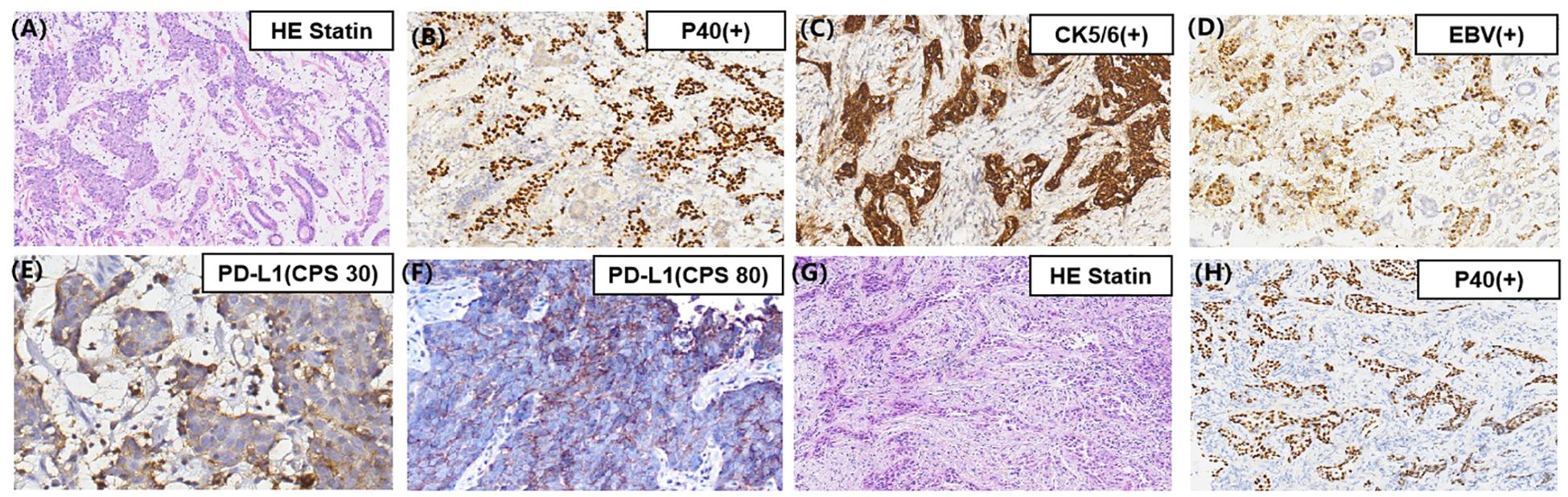 Microscopy images illustrating different staining techniques. (A) and (G) display HE Stain. (B) and (H) show positive P40 staining. (C) highlights CK5/6 positivity. (D) shows EBV positivity. (E) and (F) depict PD-L1 with CPS 30 and CPS 80, respectively. Each image presents cellular structures with varying staining intensities and patterns.