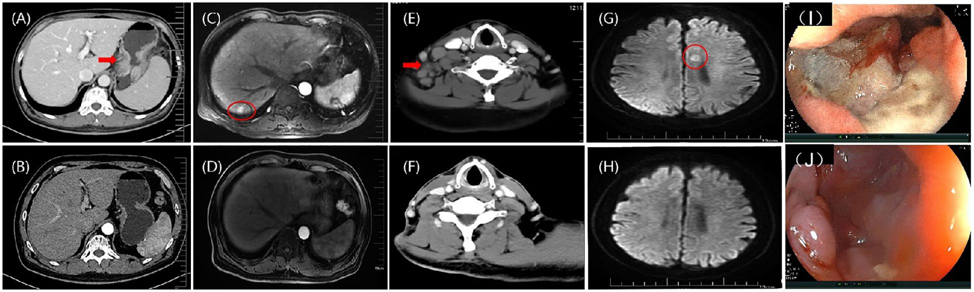 Medical imaging series showing CT and MRI scans, with some panels marked by arrows or circles to highlight areas of interest, and two endoscopic images. Panel (A) features a red arrow, while panels (C) and (G) have red circles. Panels (I) and (J) show endoscopic views, indicating possible abnormal tissue.