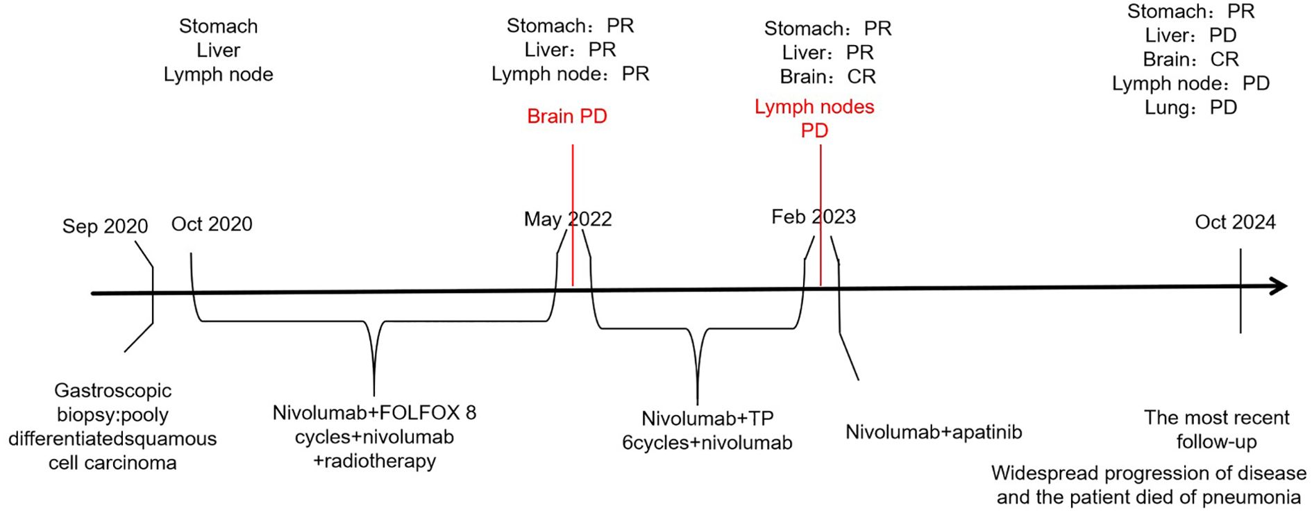Timeline of a medical treatment and follow-up for gastric squamous cell carcinoma from September 2020 to October 2024. Initial gastroscopic biopsy in September 2020. Subsequent treatments include Nivolumab with FOLFOX and radiotherapy from October 2020, Nivolumab with TP from May 2022 to February 2023, and Nivolumab with Apatinib from February 2023 to the time of disease progression. Disease progression noted in the brain in May 2022 and lymph nodes in February 2023. By October 2024, widespread disease progression and patient death due to pneumonia. Treatment responses recorded as partial response (PR) or complete response (CR) for stomach, liver, brain, lymph nodes, and lung over time.