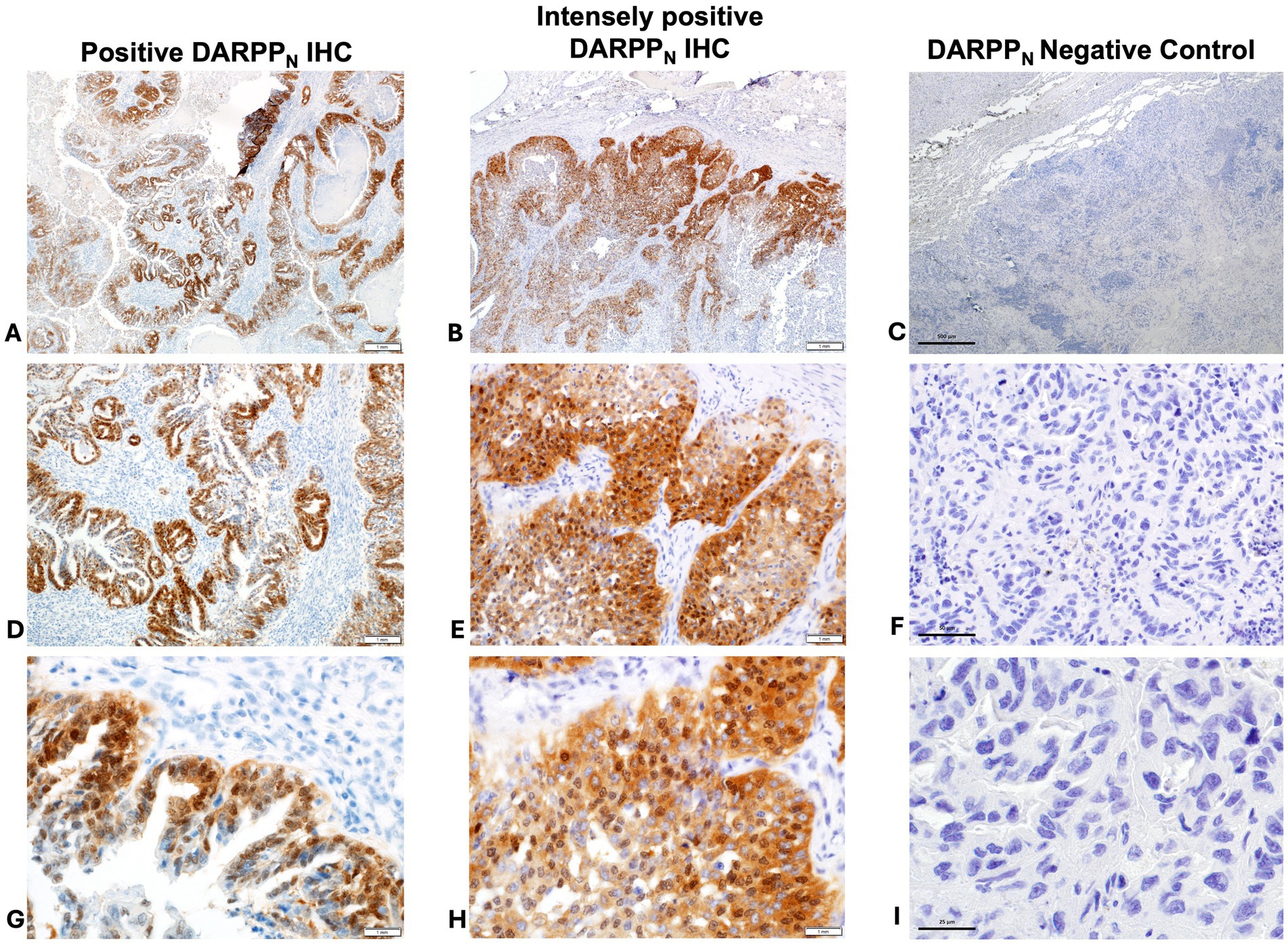 Staining visuals of tissue samples in nine panels show varying levels of DARPPN IHC positivity and a negative control. Panels A, D, and G exhibit positive DARPPN staining with brown coloring. Panels B, E, and H demonstrate intensely positive staining with pronounced brown coloration. Panels C, F, and I represent negative control samples with no noticeable brown staining, highlighting the absence of DARPPN expression. Each panel contains a scale bar for reference.
