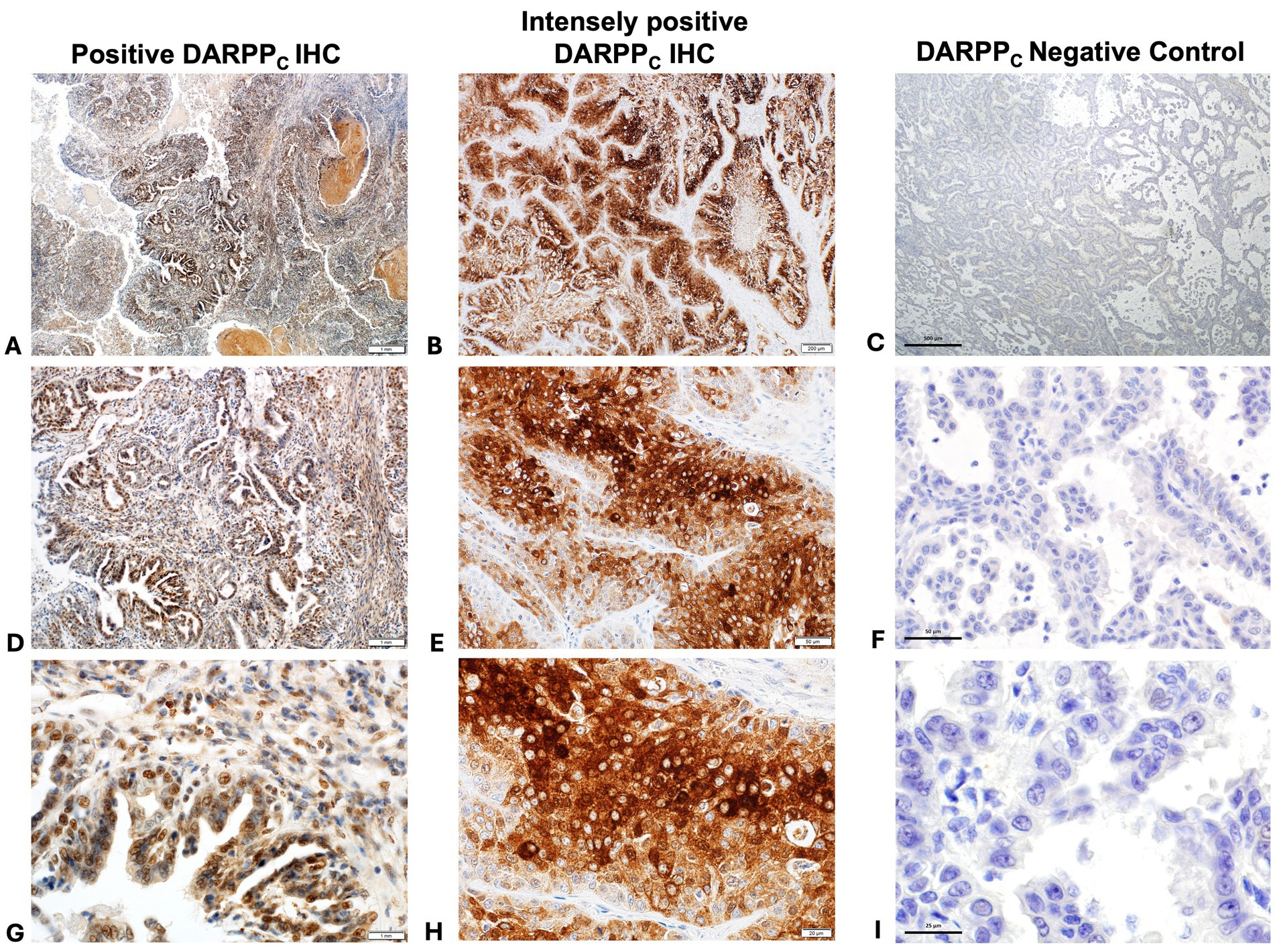 Three sets of images show immunohistochemistry (IHC) staining results. The first column displays positive DARPPc IHC with varying intensities. The second column shows intensely positive DARPPc IHC, noted by strong brown staining. The third column serves as a negative control with minimal staining. Each column contains three images with increasing magnification from top to bottom, highlighting tissue and cellular details.