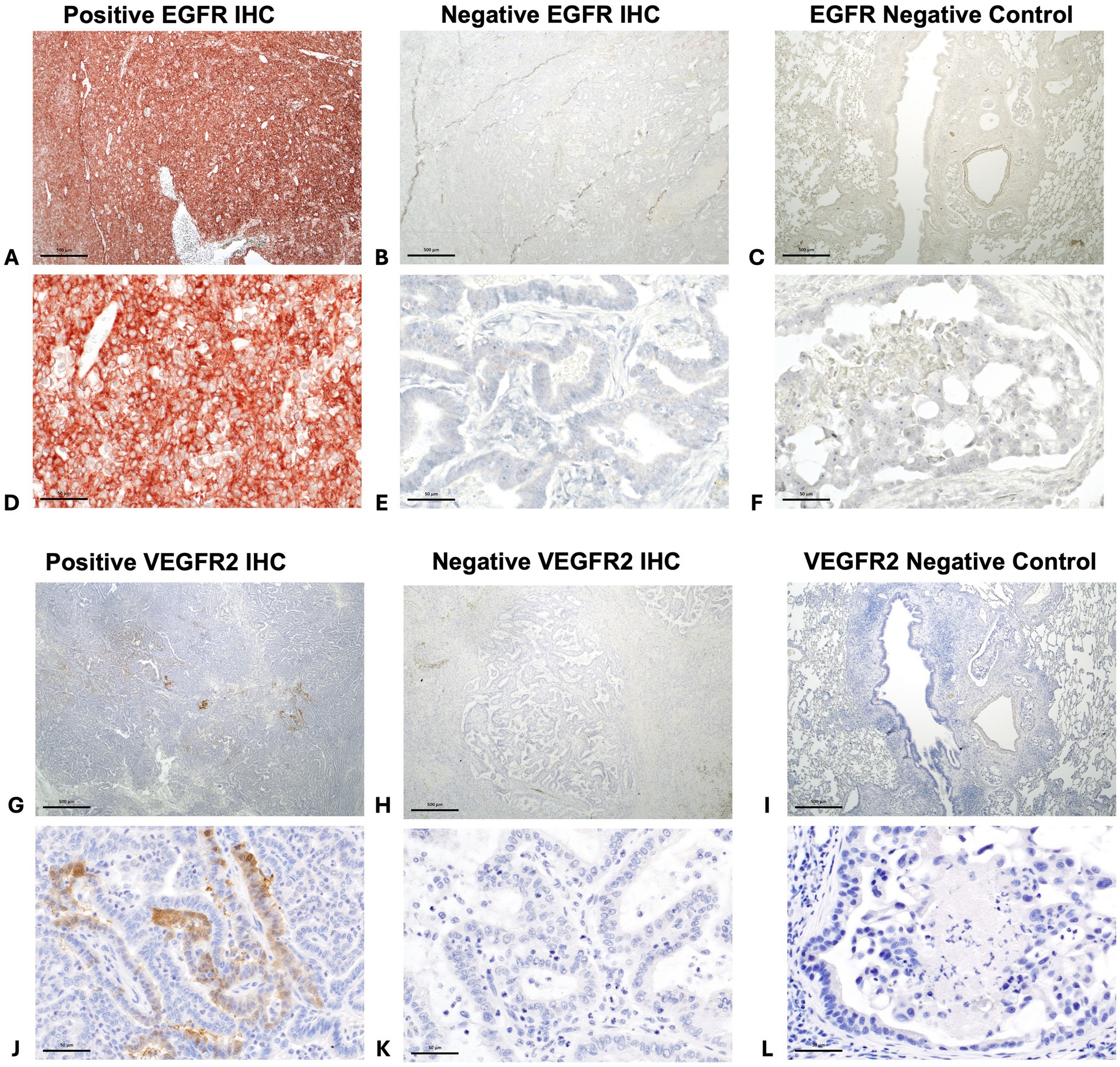 Immunohistochemistry images arranged in four rows and three columns. Top row displays positive and negative staining for EGFR, with a control image. The first row shows strong red staining for positive EGFR, faint staining for negative EGFR, and a control without staining. The second row depicts a similar pattern with closer magnification. The third and fourth rows show VEGFR2 staining, with the first image showing positive staining, the second showing negative, and the third as control. Each section represents different levels of staining intensity and cellular detail.