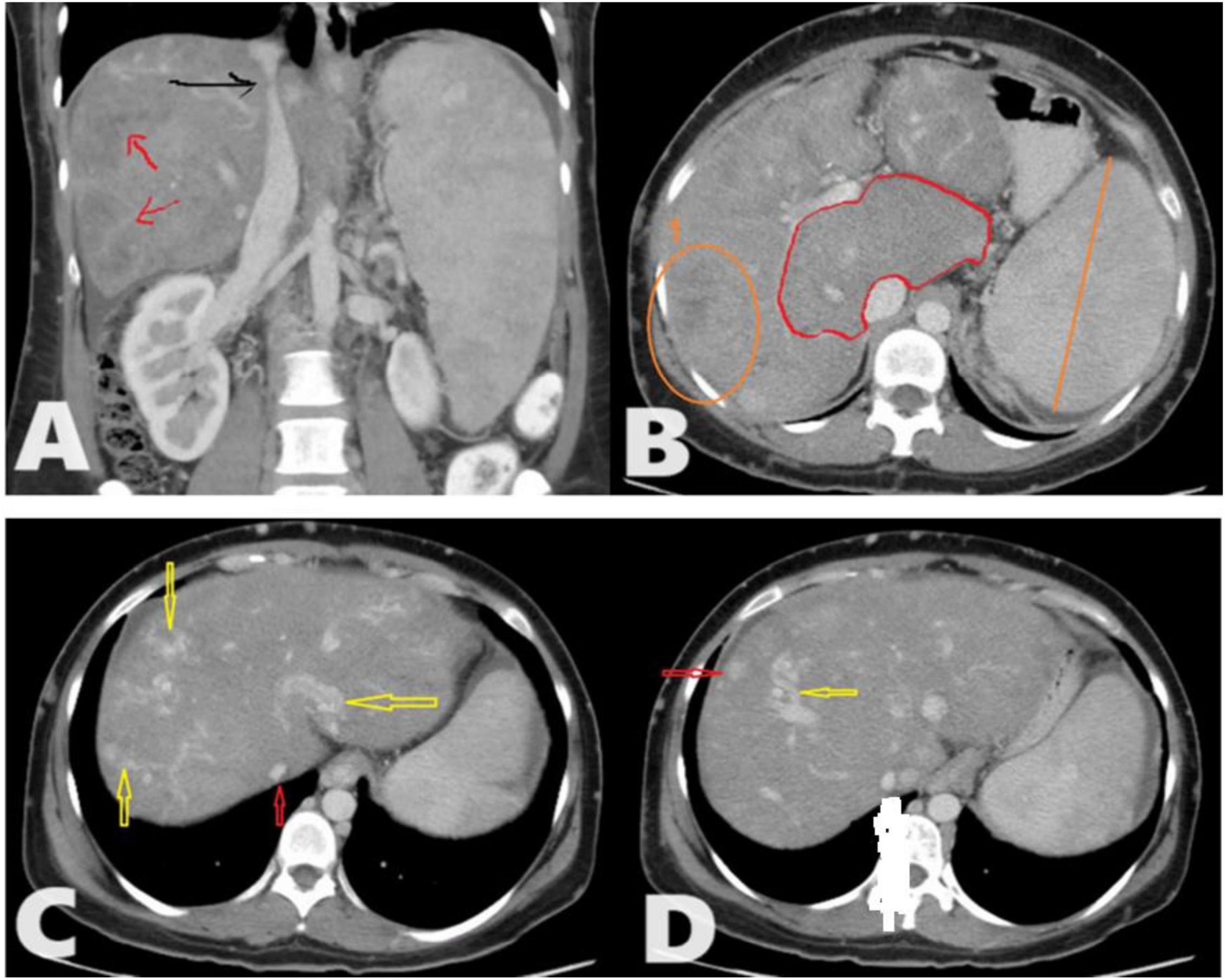 CT scan images showing different views of the liver with annotations. Image A displays the liver in a vertical section with black and red arrows. Image B shows a horizontal section with red and orange outlines. Image C features yellow and red arrows pointing to areas in a horizontal section. Image D presents a similar horizontal view with a yellow arrow and a red line highlighting regions in the liver.