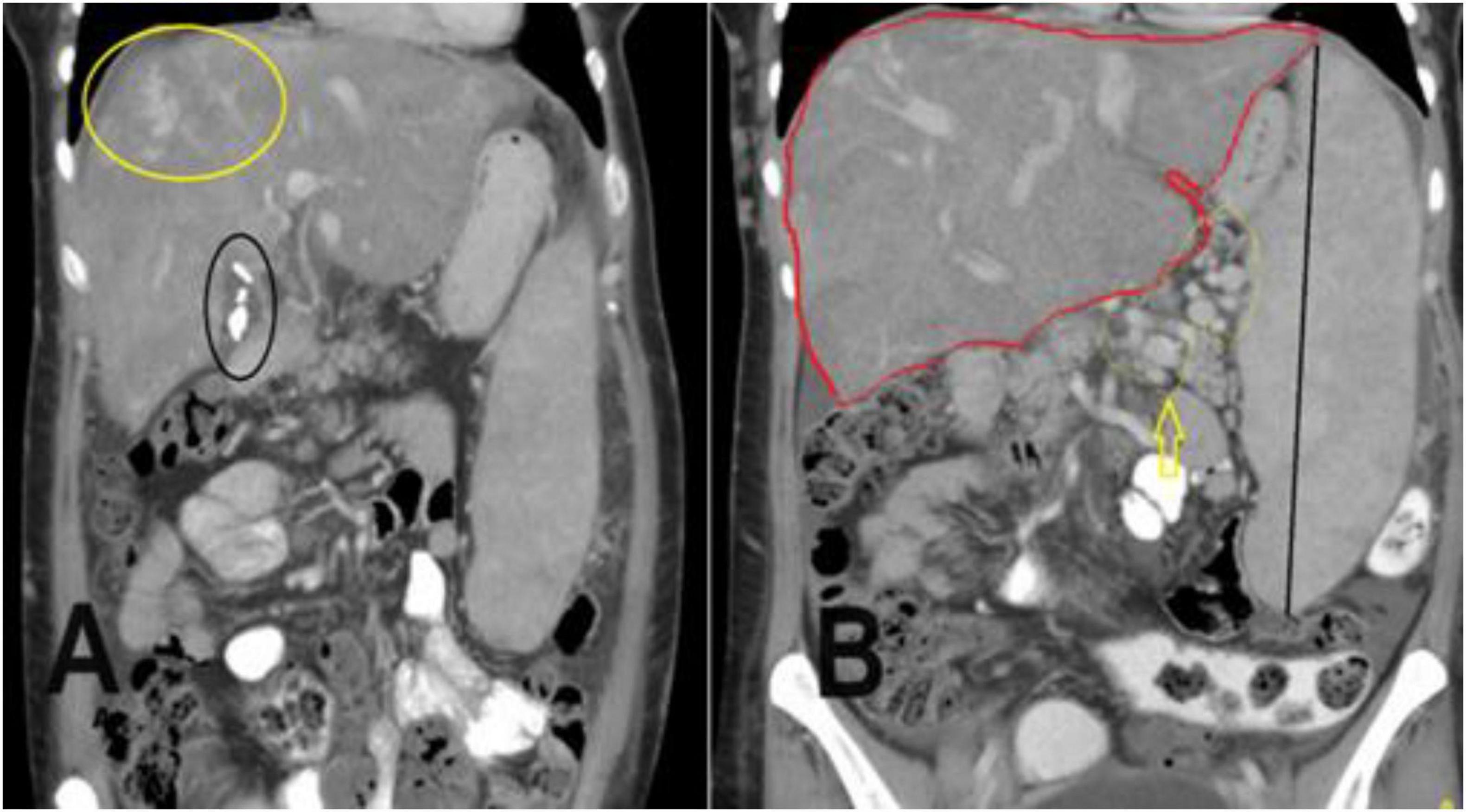 CT scan images labeled A and B show abdominal cross-sections. Image A features a yellow circle highlighting a region in the upper abdomen and a black oval marking a small area. Image B includes a red outline over a large section and a yellow arrow pointing to a specific spot, possibly indicating points of interest or anomalies.