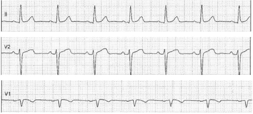 Electrocardiogram (ECG) traces showing three different leads: lead II, V2, and V1. The traces exhibit regular patterns with distinct P waves, QRS complexes, and T waves, indicating cardiac electrical activity.