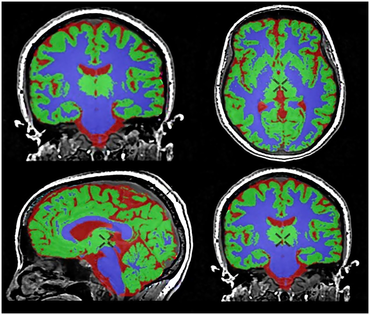MRI scan showing four colored cross-sections of the brain, highlighting different regions. Blue areas represent the brain's interior, green represents the outer cortex, and red outlines various structural boundaries, set against a black background.