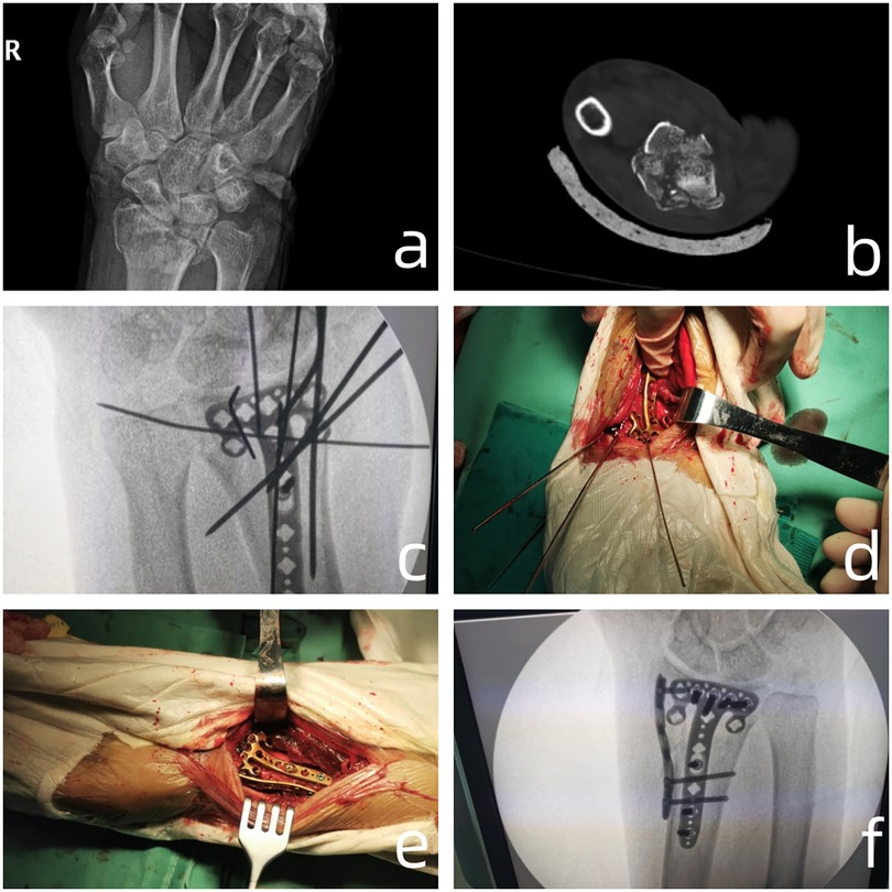Panel a shows an x-ray of a wrist with bones visible. Panel b presents a CT scan cross-section. Panel c displays an x-ray with surgical hardware in place. Panel d depicts an open wrist surgery with visible tools and pins. Panel e shows a close-up of the wrist with surgical plates attached. Panel f illustrates an x-ray with plates fixed to the wrist bones.