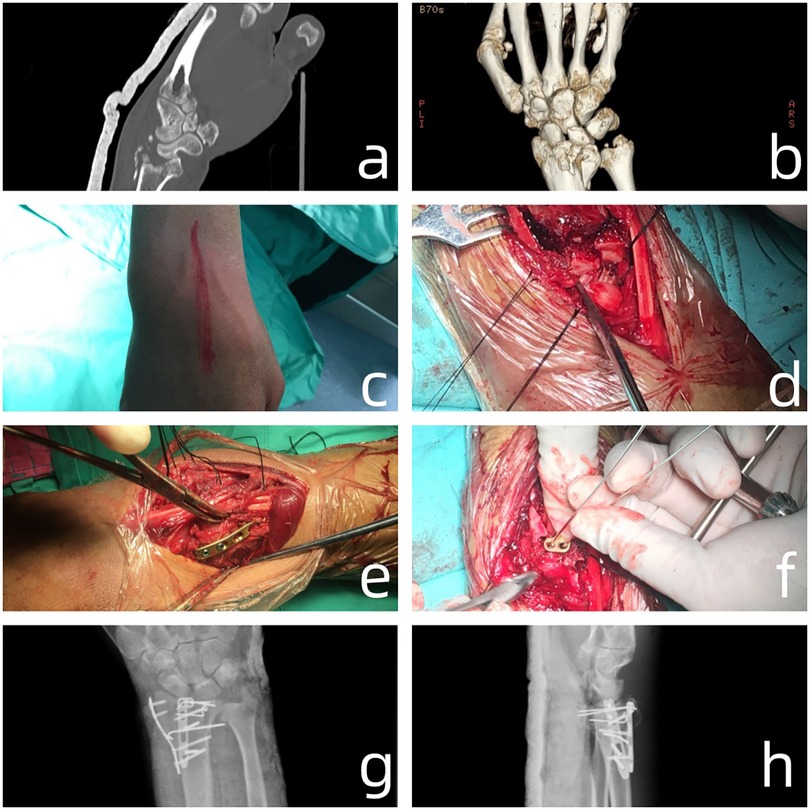 Panel of eight images showing a medical case: (a) CT scan of a forearm with a visible fracture. (b) 3D rendering of wrist bones. (c) Forearm with a surgical mark. (d–f) Surgical procedure with exposed forearm and tools. (g) and (h) x-rays of the forearm with internal fixation hardware.