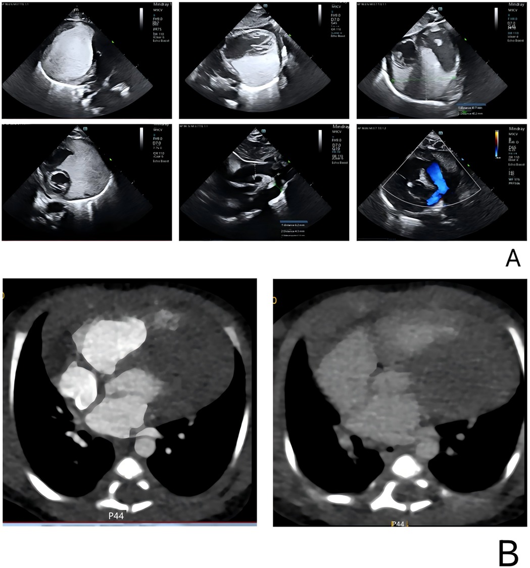 Six ultrasound images of the heart (panel A) and two CT scans of the heart (panel B). The ultrasound shows various views of liver structure and blood flow in color. The CT scans display different sections of the heart and surrounding anatomy.