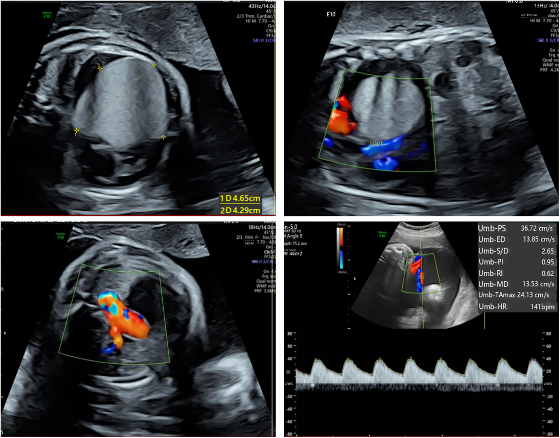 Ultrasound images showing fetal development in panels. Top left showsa hyperechoic mass in the left ventricle. Top right and bottom left display color Doppler imaging of blood flow. Bottom right includes a Doppler waveform with measurements for fetal heart rate, recorded at 141 bpm.