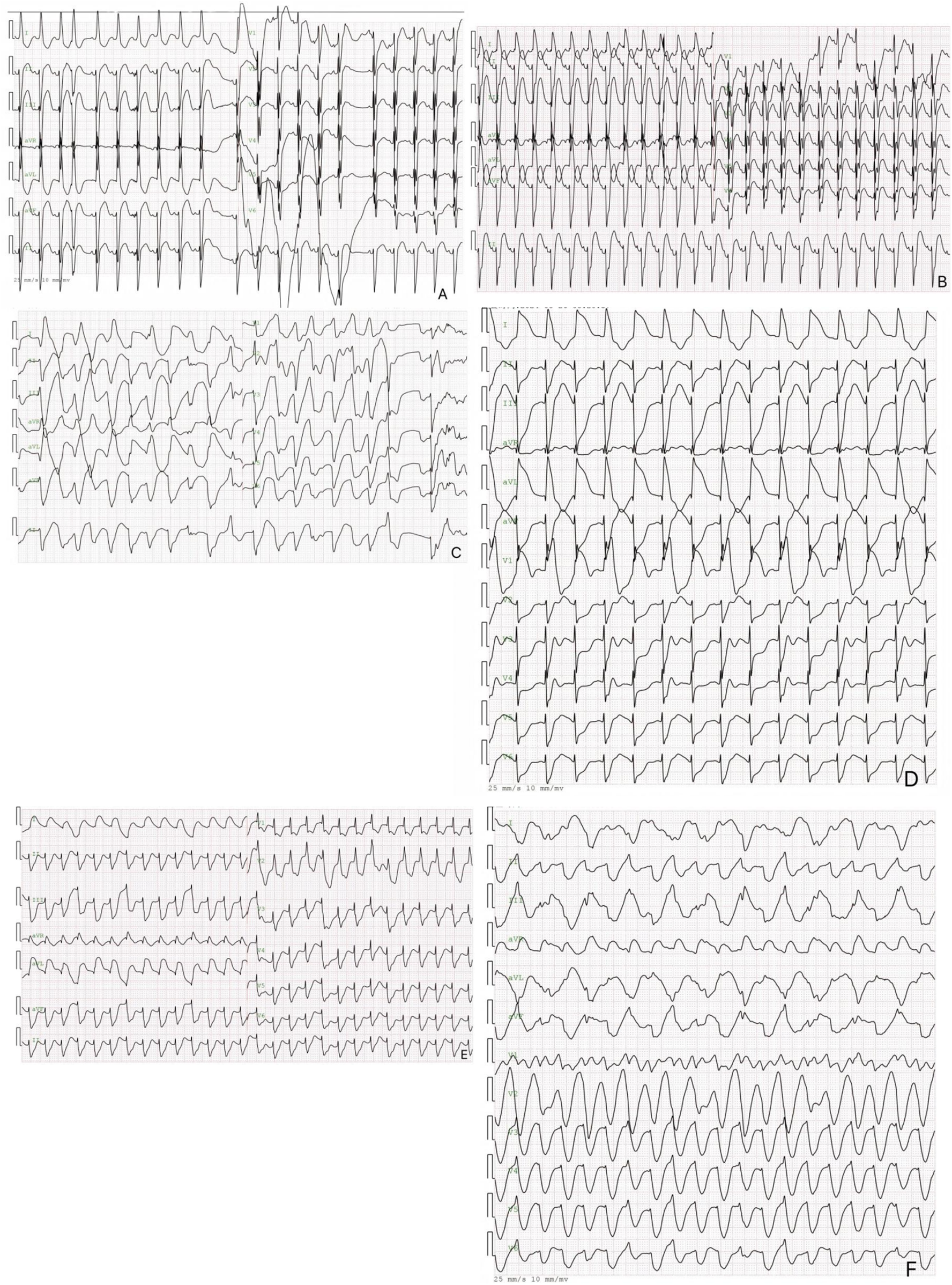 Six panels labeled A to F display the ECG results of the child measured from birth to the 8th day after birth. Each panel shows different patterns of heart electrical activity, with varying waveforms indicating different cardiac rhythms and anomalies. The tracings consist of repetitive peaks and troughs on a grid, illustrating diverse heart rates and electrical conduction variations.