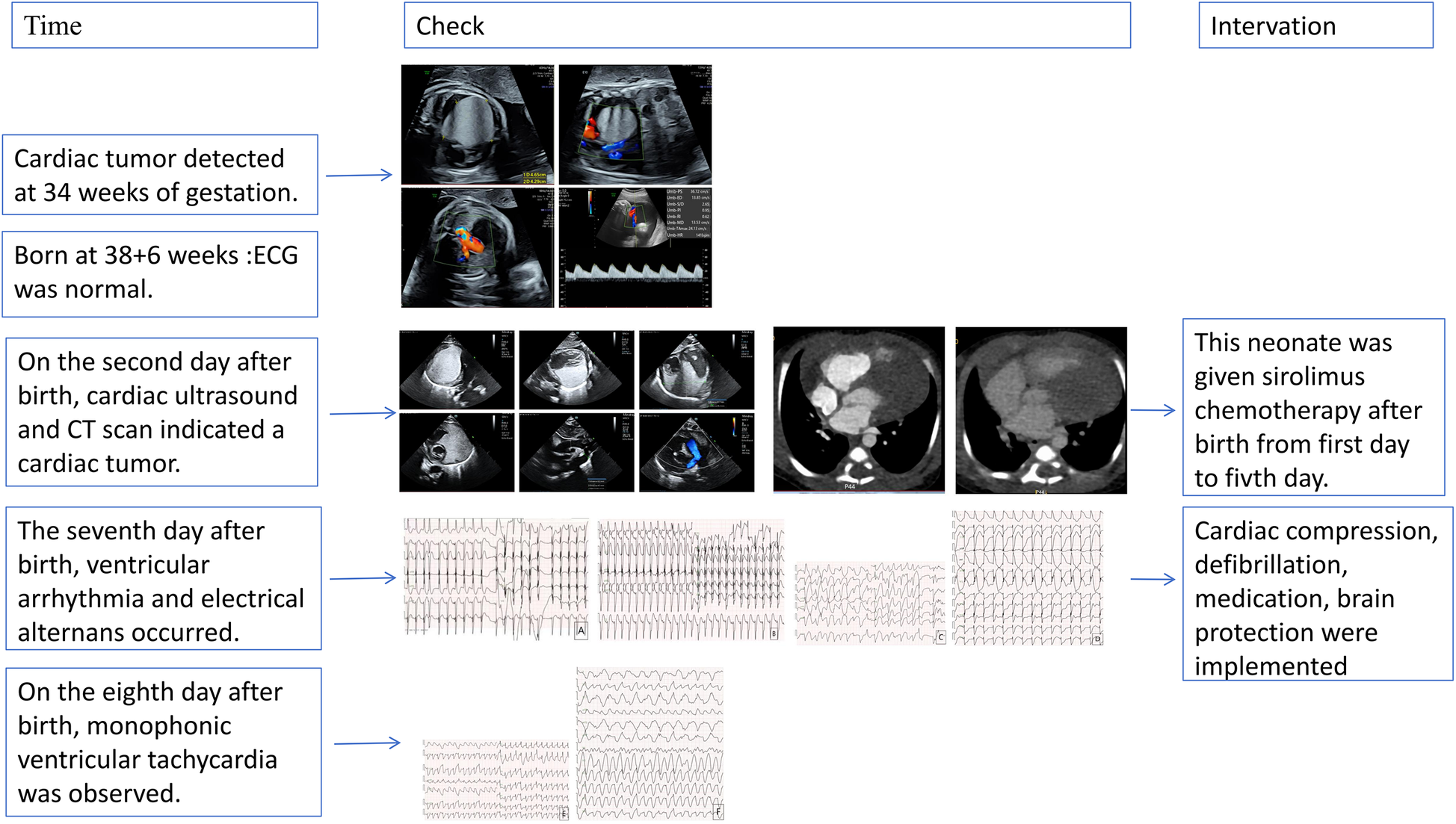Timeline chart showing the diagnosis and treatment of a neonatal cardiac tumor. Left column lists critical time points: detection at 34 weeks gestation, birth with normal ECG, and tumor indications on day two post-birth. Middle column displays corresponding ultrasound, CT scans, and ECG results. Right column outlines interventions.