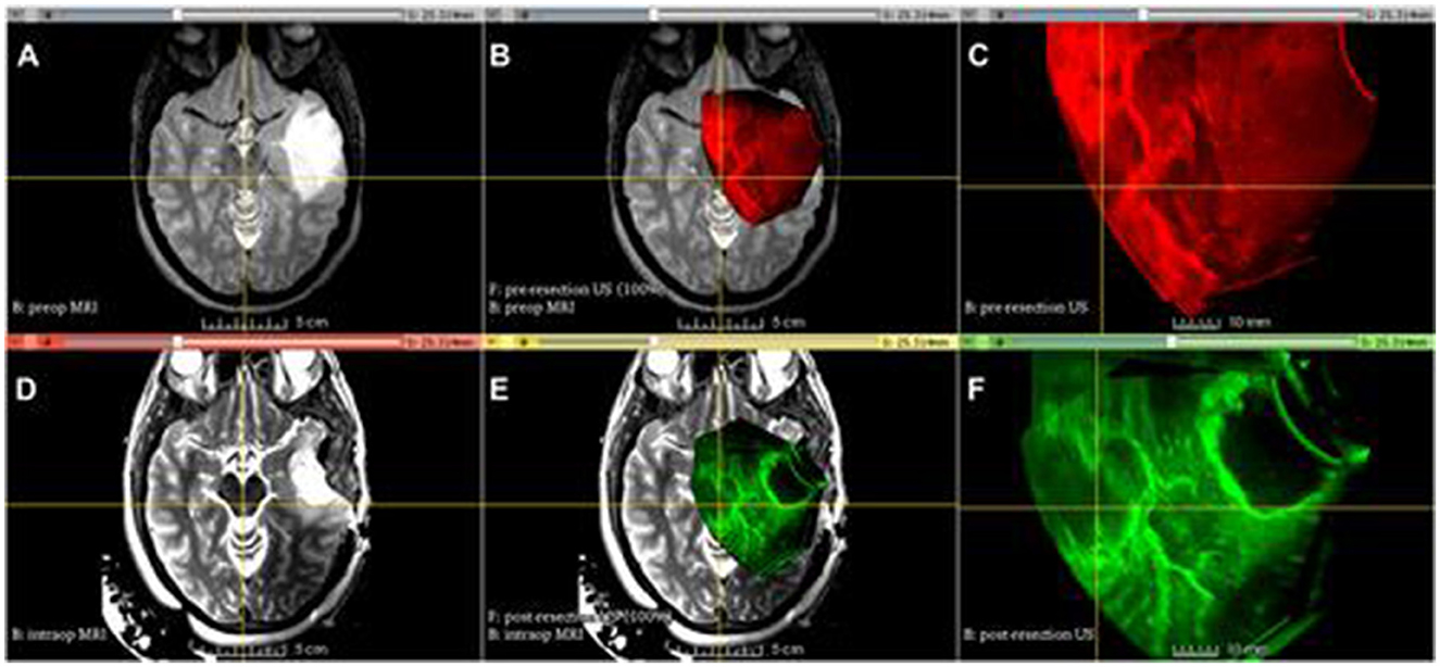 Brain scan images in a grid with six panels labeled A to F. Panels A, B, D, and E show MRI scans highlighting different brain regions. Panels C and F display ultrasonography images with red and green areas, indicating different levels of activity or tissue types. Each panel appears to represent different stages or techniques of imaging, possibly pre and post-procedure.