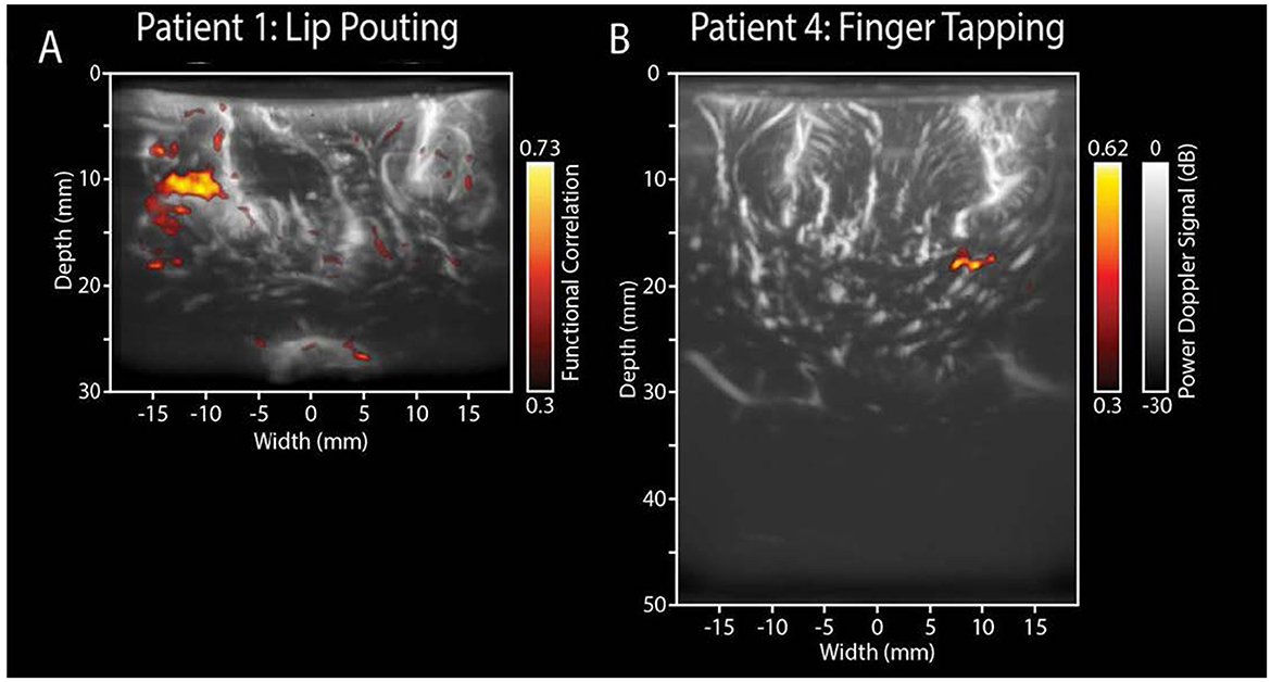 Ultrasound images show brain activity. Panel A depicts functional correlation in Patient 1 during lip pouting, with high activity in yellow. Panel B shows power Doppler signal in Patient 4 during finger tapping, with significant activity in orange. Both panels include depth and width measurements, with color scales indicating activity levels.
