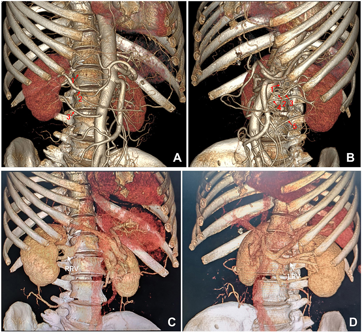 CT scan images showing the thoracic and abdominal region. Panel A and B display a vascular network with labeled arteries in the upper body. Panels C and D show the kidneys and surrounding vascular structures, with labels RRV and LRV indicating renal veins. The ribs and spine are prominently visible throughout.