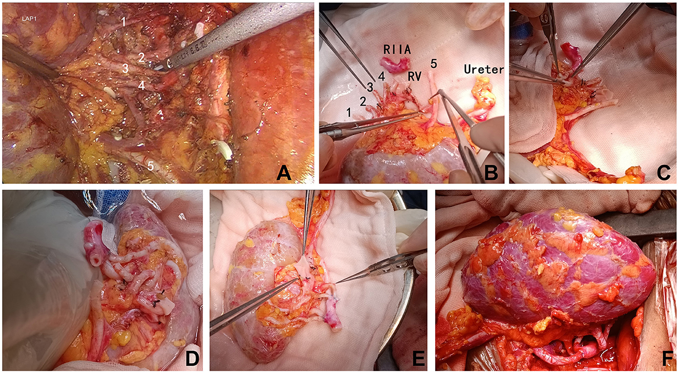 Surgical procedure images showing different stages of an abdominal operation. Panels A to F depict dissection and removal of tissue, with labeled anatomical structures such as arteries and ureter. Surgical tools are visible, and the tissue varies in color and texture.
