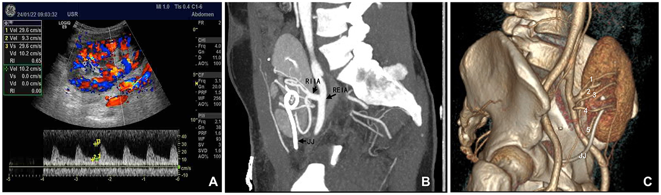 Panel A shows an ultrasound with color Doppler imaging of blood flow, displaying velocity measurements. Panel B presents a sagittal CT scan highlighting arterial placement in the abdomen. Panel C provides a 3D-rendered CT showing the anatomical structure of the pelvis and abdomen, including labeled arteries and anatomical features.