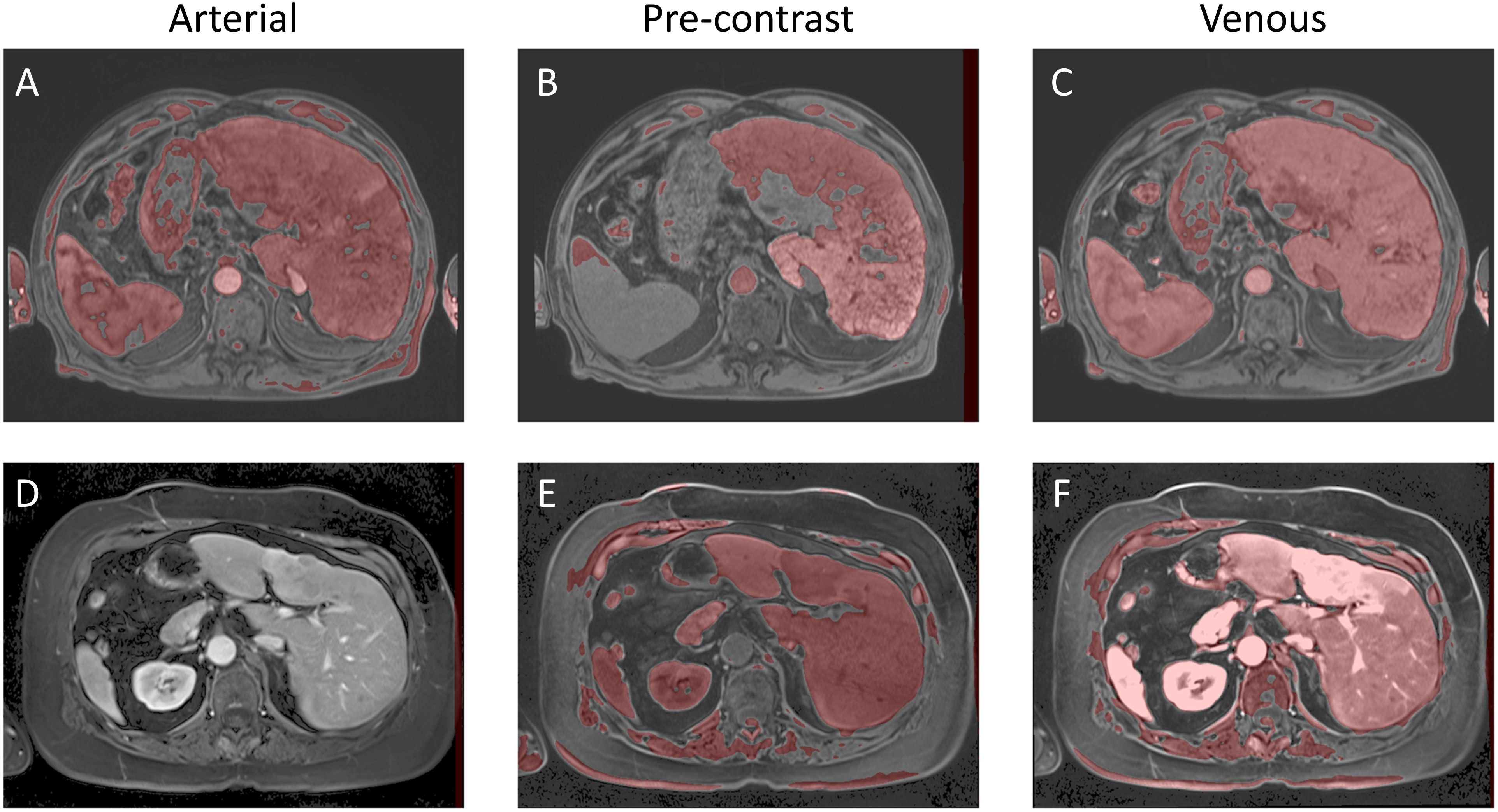 Six MRI images compare arterial (A, D), pre-contrast (B, E), and venous (C, F) phases. Red-tinted areas indicate liver tissue differentiation, highlighting contrast changes across phases.