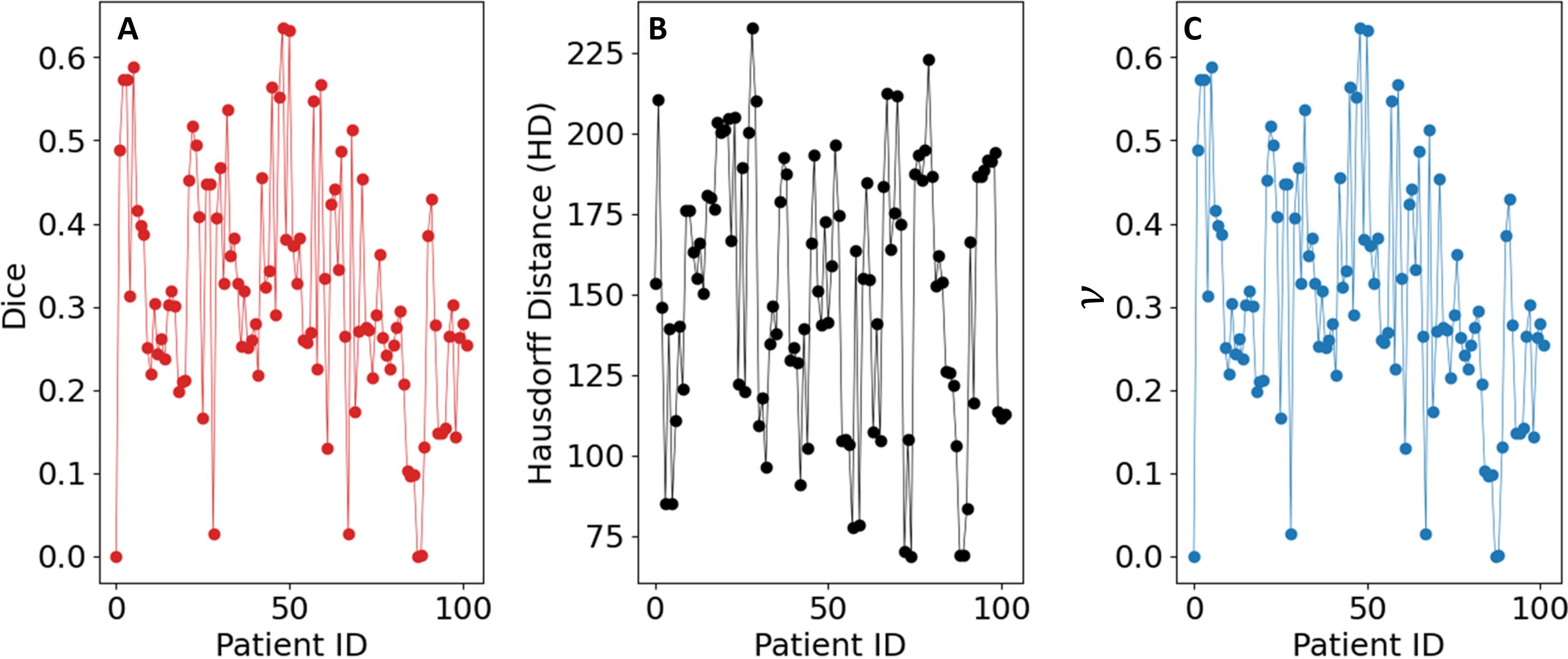 Three scatter plots labeled A, B, and C, each displaying data against Patient ID on the x-axis. Plot A has red dots showing Dice values ranging from 0.0 to 0.7. Plot B, with black dots, measures Hausdorff Distance (HD) from 75 to 225. Plot C shows blue dots with nu values ranging from 0.0 to 0.7. Data is connected by lines in each plot.
