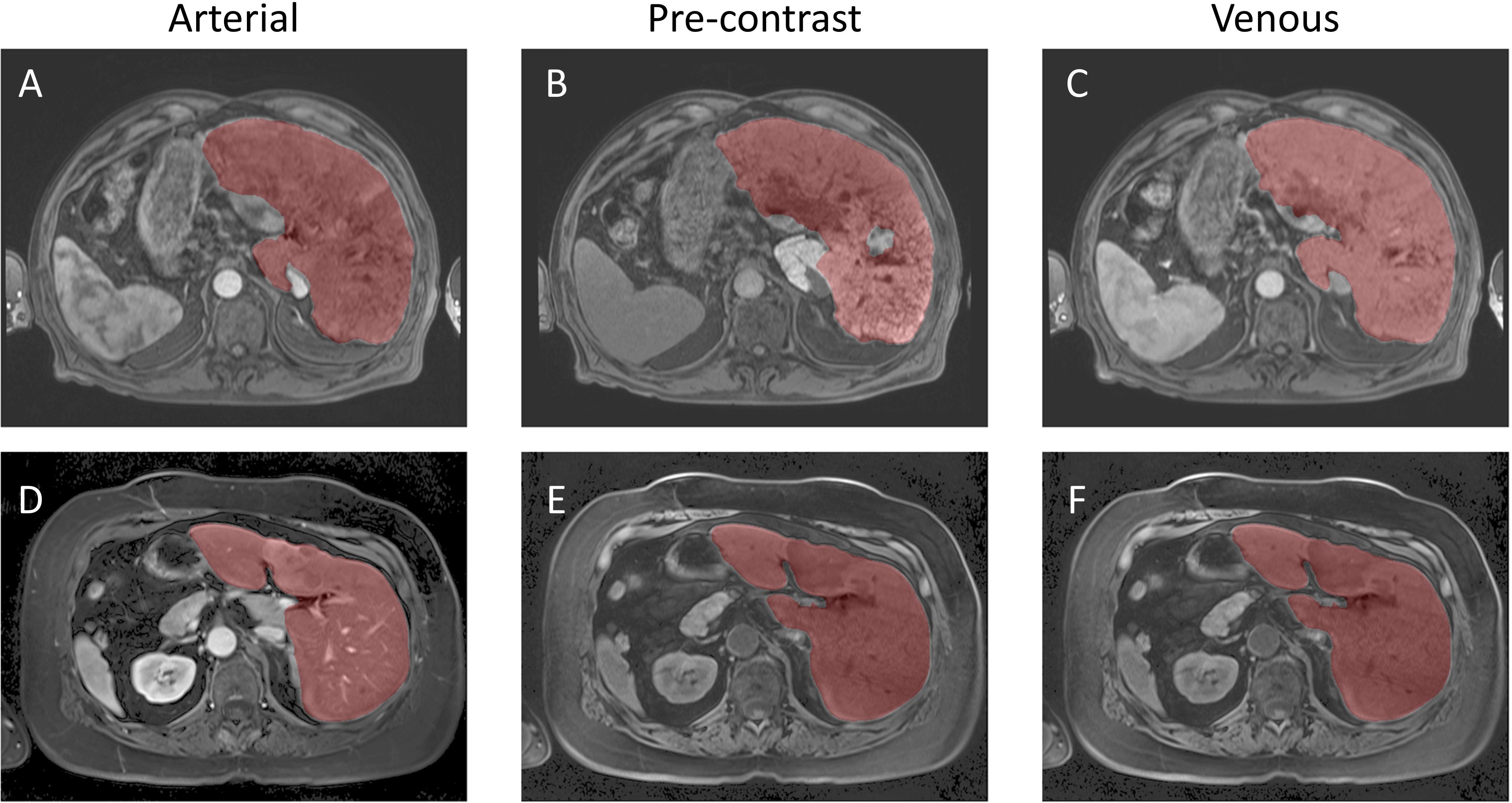 Six MRI images are labeled A to F, showing transverse liver sections. Images are categorized into arterial (A, D), pre-contrast (B, E), and venous phases (C, F). The liver is highlighted in red, indicating areas of interest or abnormalities in different imaging phases. Each row represents similar imaging phases under different conditions.
