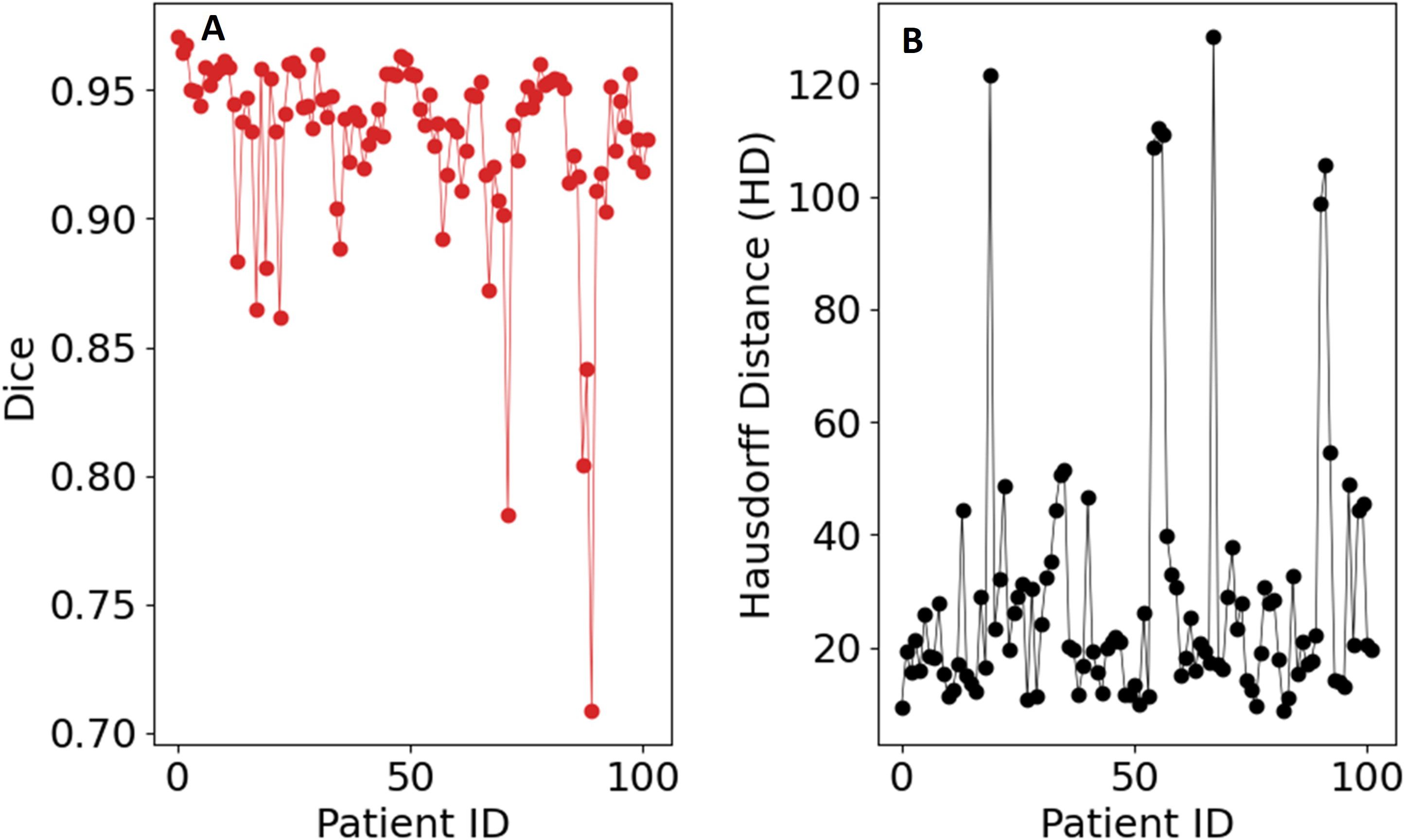 Graph A on the left shows Dice scores versus Patient ID, with scores mostly above 0.85 but with several dips. Graph B on the right displays Hausdorff Distance versus Patient ID, with varying distances, some exceeding 100.