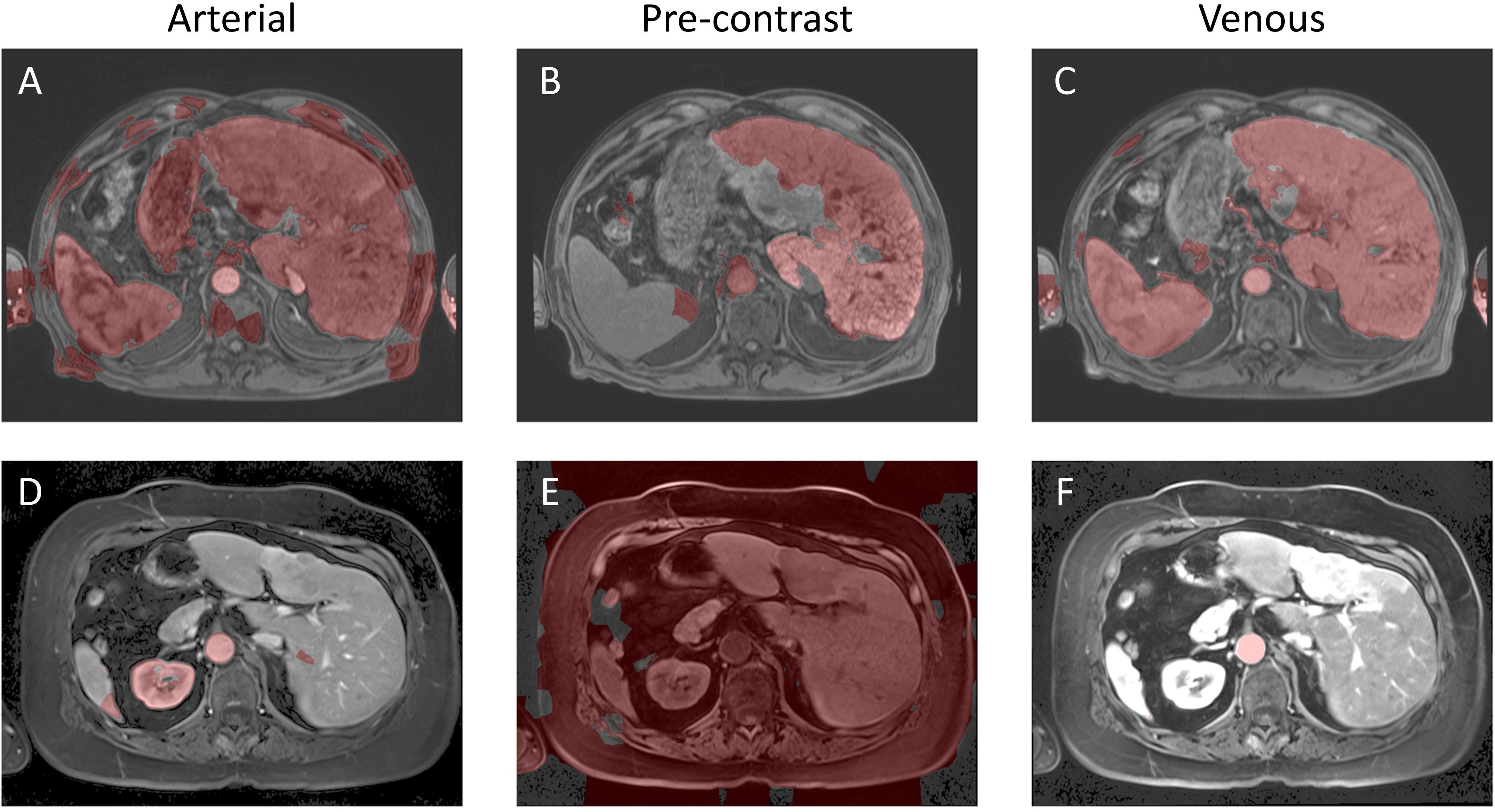 MRI scans of abdominal regions labeled A to F. Panels A, B, and C show arterial, pre-contrast, and venous phases, respectively, with highlighted areas in red. Panels D, E, and F display corresponding scans with different shading, indicating variations in tissue density or contrast in the same phases.
