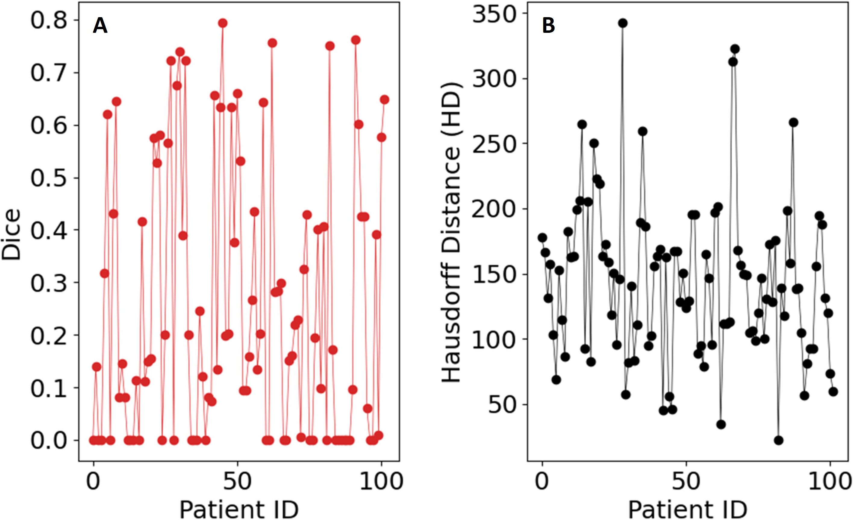 Two line graphs are displayed. Graph A on the left shows Dice scores for patient IDs ranging from zero to one hundred, with values between zero and 0.8. Graph B on the right depicts Hausdorff Distances for the same patient IDs, with values from zero to 350.