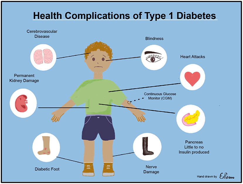 Illustration of a child with labels pointing to health complications of Type 1 Diabetes: cerebrovascular disease, kidney damage, diabetic foot, nerve damage, blindness, heart attacks, use of continuous glucose monitor, and pancreas producing little to no insulin.