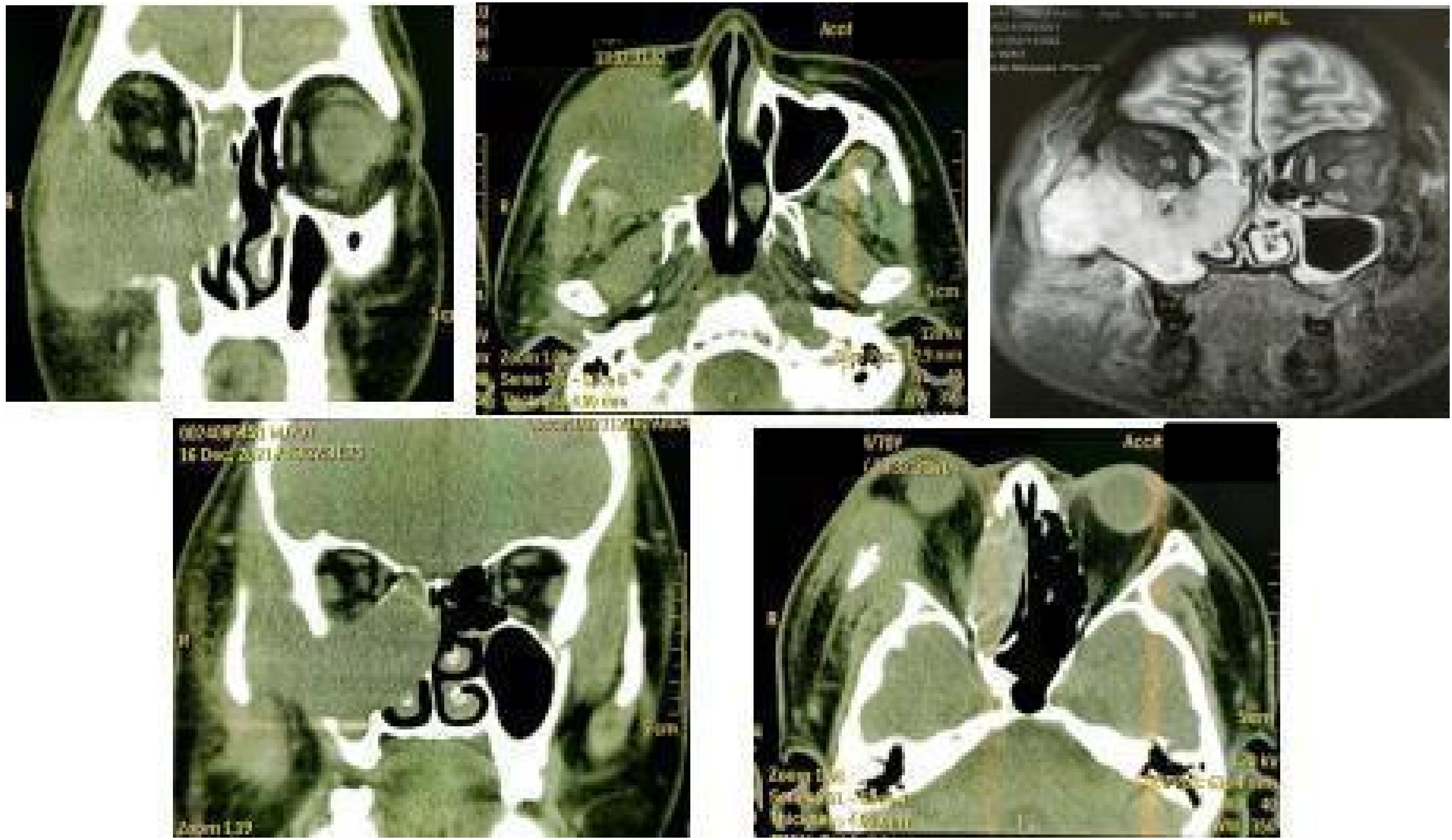 CT and MRI scans of the nasal and sinus regions are shown in five panels. Various axial and coronal views highlight structures, air cavities, and potential abnormalities. The images display cross-sections of bone and soft tissues, aiding in diagnosis and assessment.