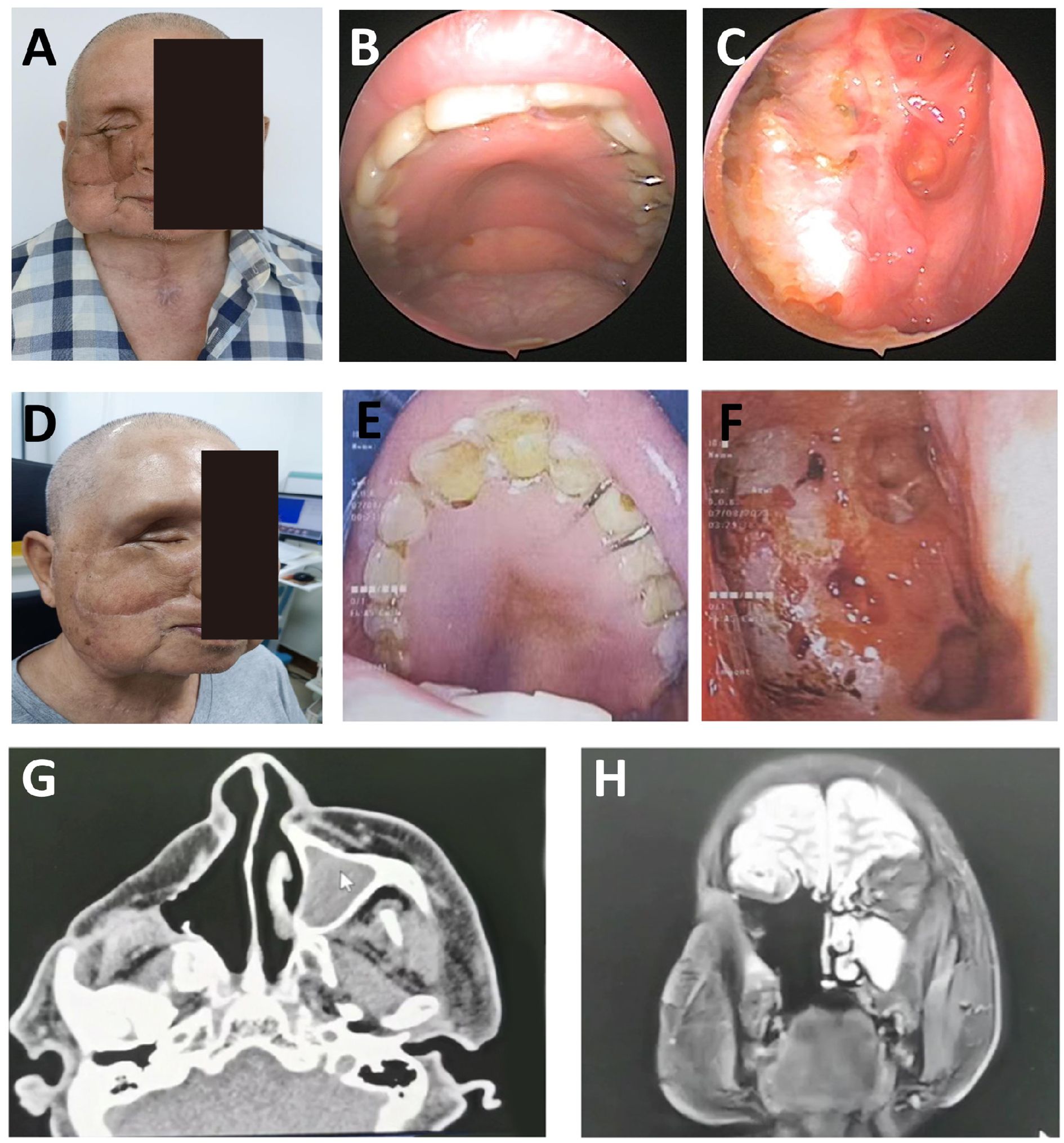 A series of medical images illustrating a case study. Panel A and Panel D show the patient’s postoperative facial appearance. Panels B and E depict intraoral views revealing dental and mucosal changes. Panel C and Panel F present postoperative nasal endoscopic views. Panel G shows postoperative CT images. Panel H shows postoperative MRI images.