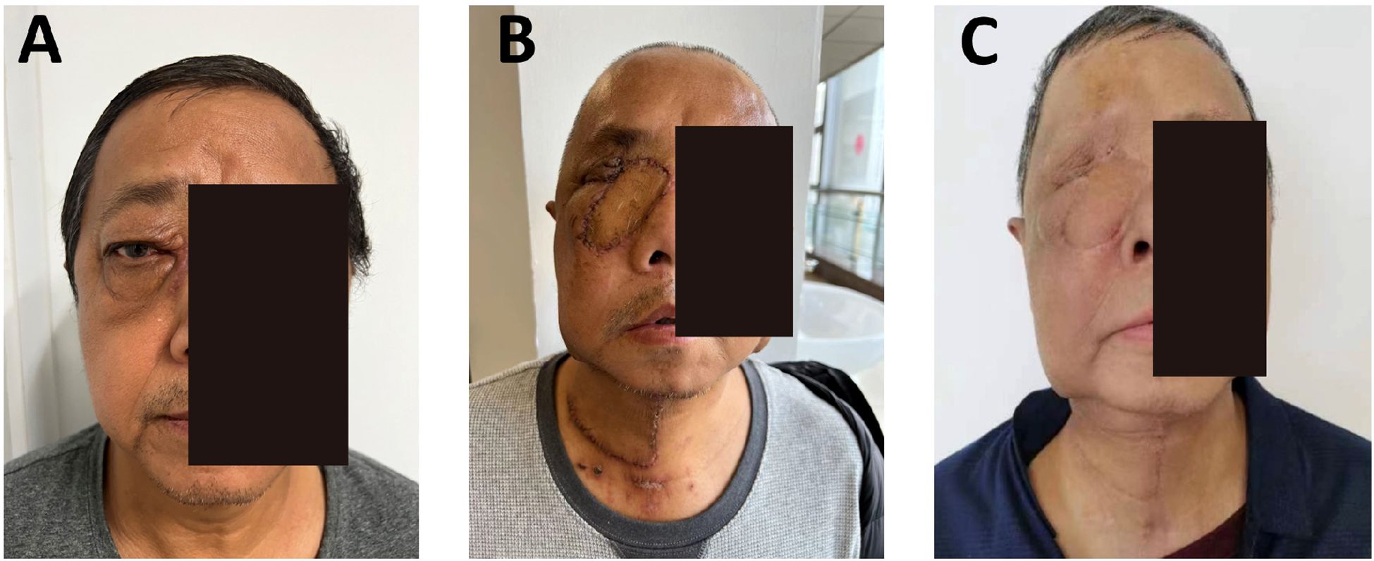 Three-panel image depicting a medical case. Panel A shows a man's face with a swelling under the right eye. Panel B displays surgical wounds with stitches on the same side of the face. Panel C shows the healed post-surgical appearance with visible scarring.