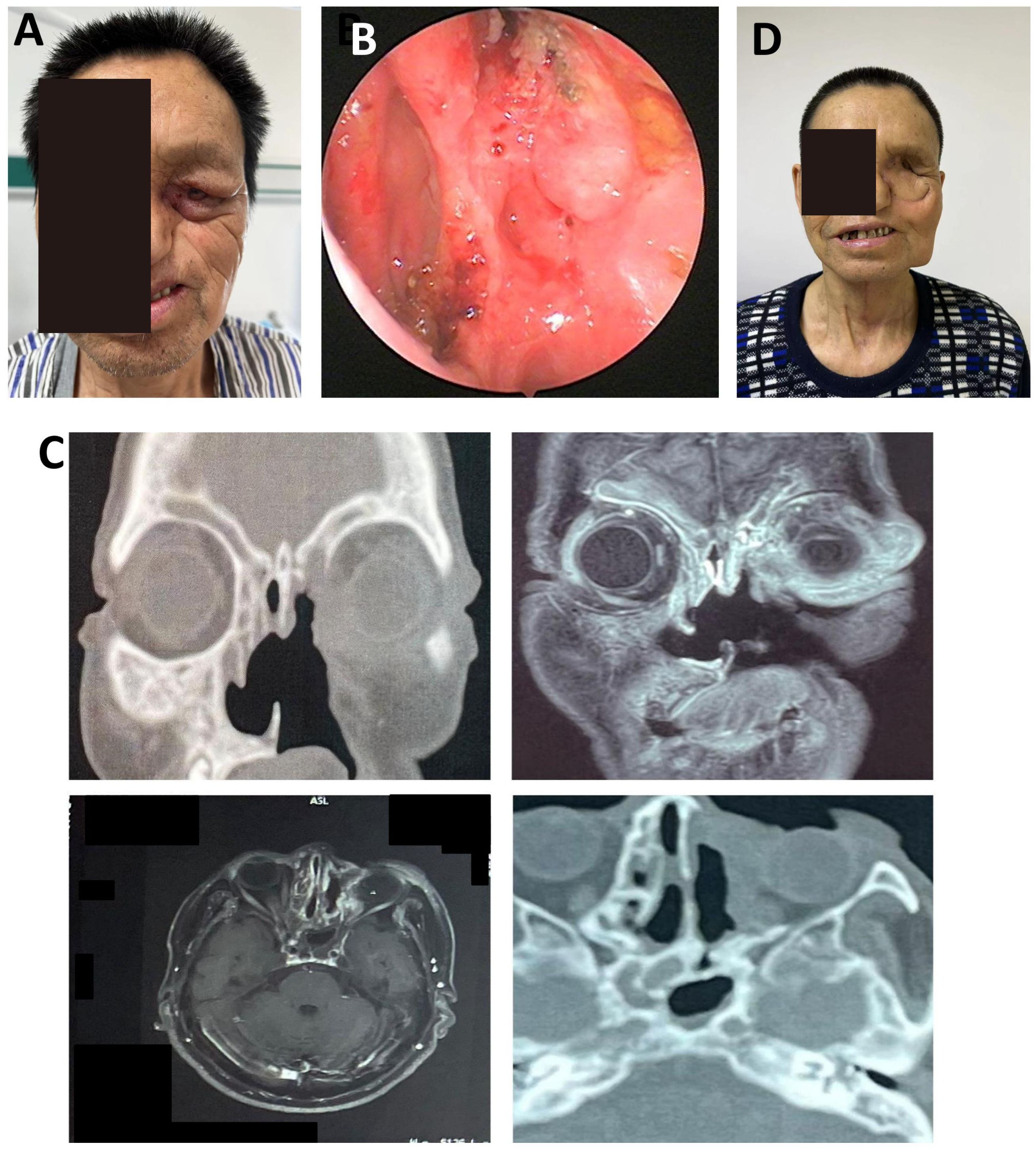 Panel A shows a person with facial swelling around the eye. Panel B displays an endoscopic view showing abnormal nasal tissue changes. Panel C contains four different CT and MRI scans of the sinus and head, indicating abnormalities. Panel D shows the patient’s postoperative facial appearance with improvement in swelling.