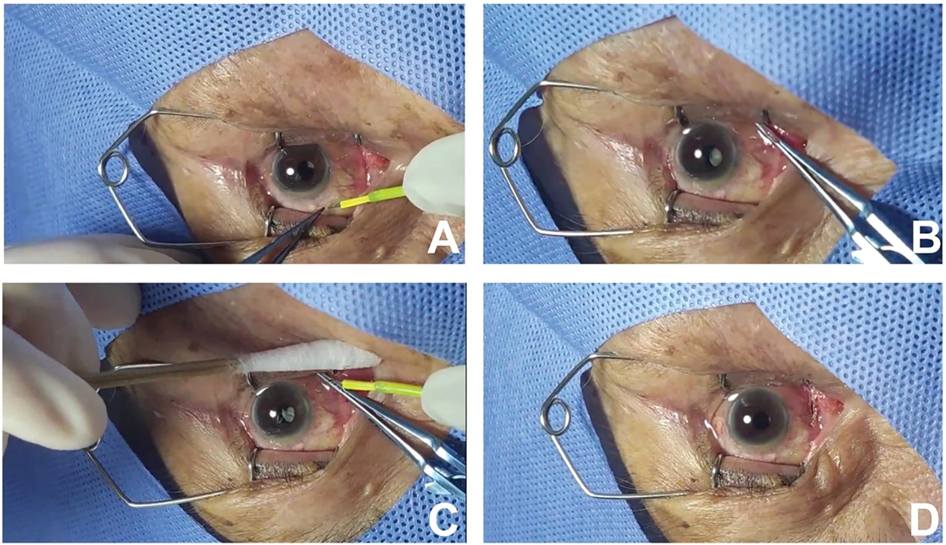 Four-panel sequence showing an eye surgery with a retractor holding the eyelid open. Panel A: Instruments prepare the incision. Panel B: Surgical tools work near the eye. Panel C: A cotton swab and tool near the eye. Panel D: Eye post-procedure.