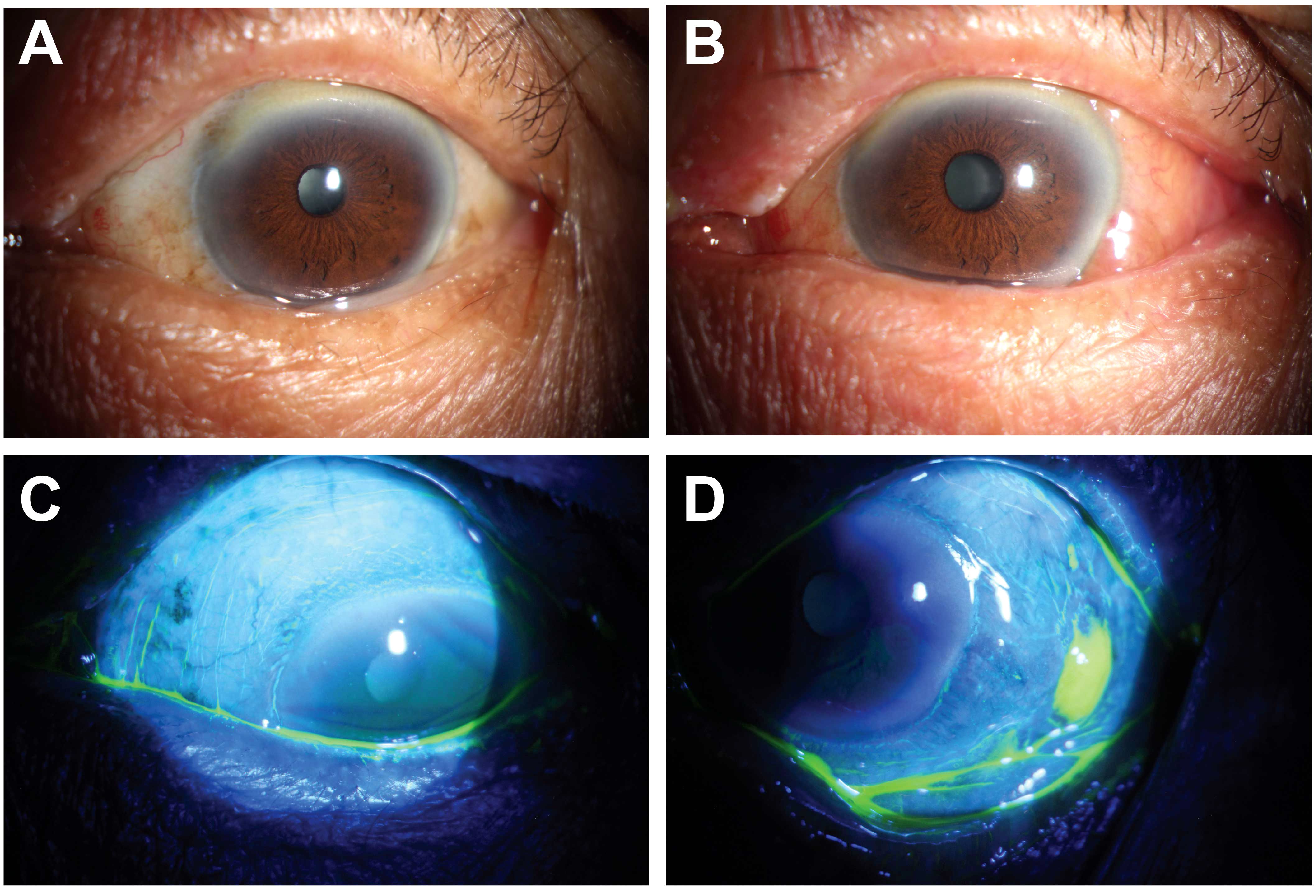 Close-up images of an eye in four panels. Panel A and B show the eye under normal lighting, revealing a hazy corneal surface. Panels C and D display the eye under blue light with fluorescent dye, highlighting irregularities and a stained area on the cornea.