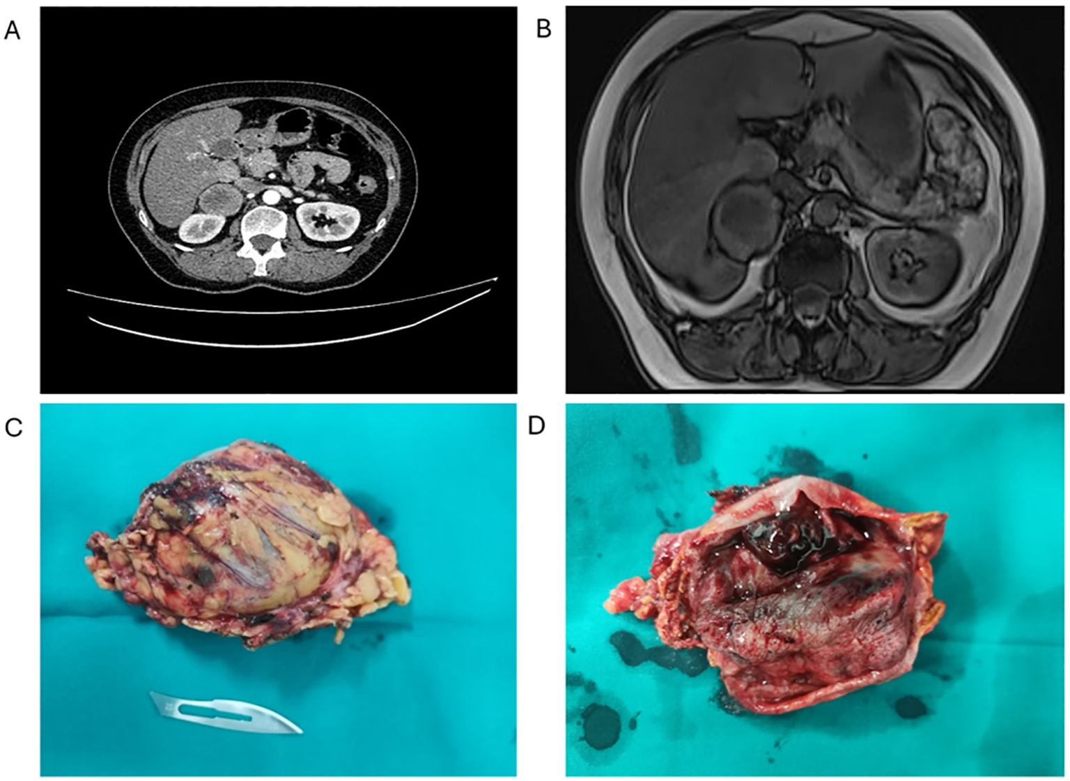 CT scan image labeled “A” shows an axial view of the abdomen, displaying internal organs and structures. MRI image labeled “B” depicts a similar axial view with different contrast, highlighting soft tissue details in the abdominal region.