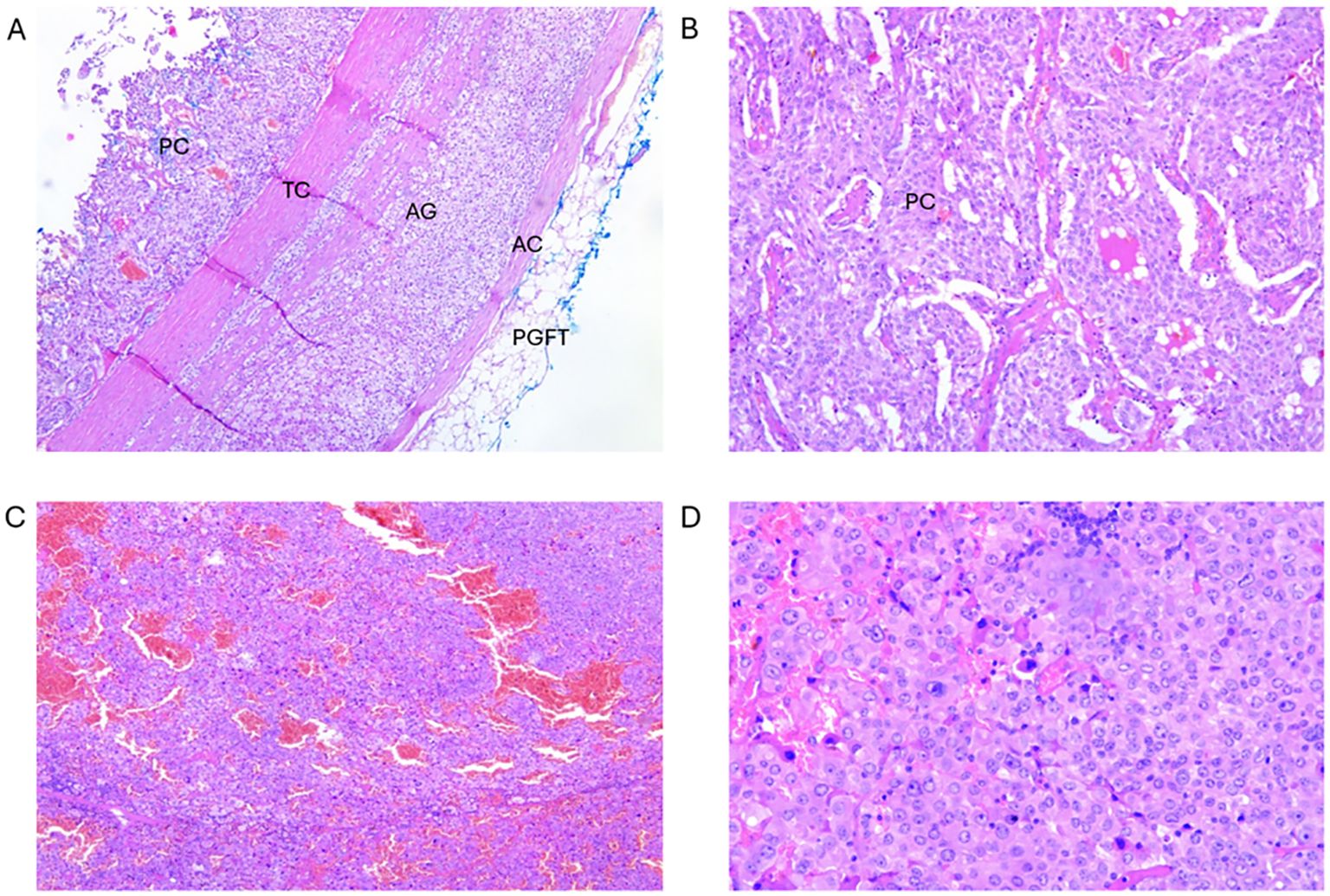 Two images labeled A and B show surgical specimens placed on a blue cloth. Image A contains a mass with a scalpel beside it for scale. Image B displays the mass further dissected, revealing internal structures with dark and marbled textures.